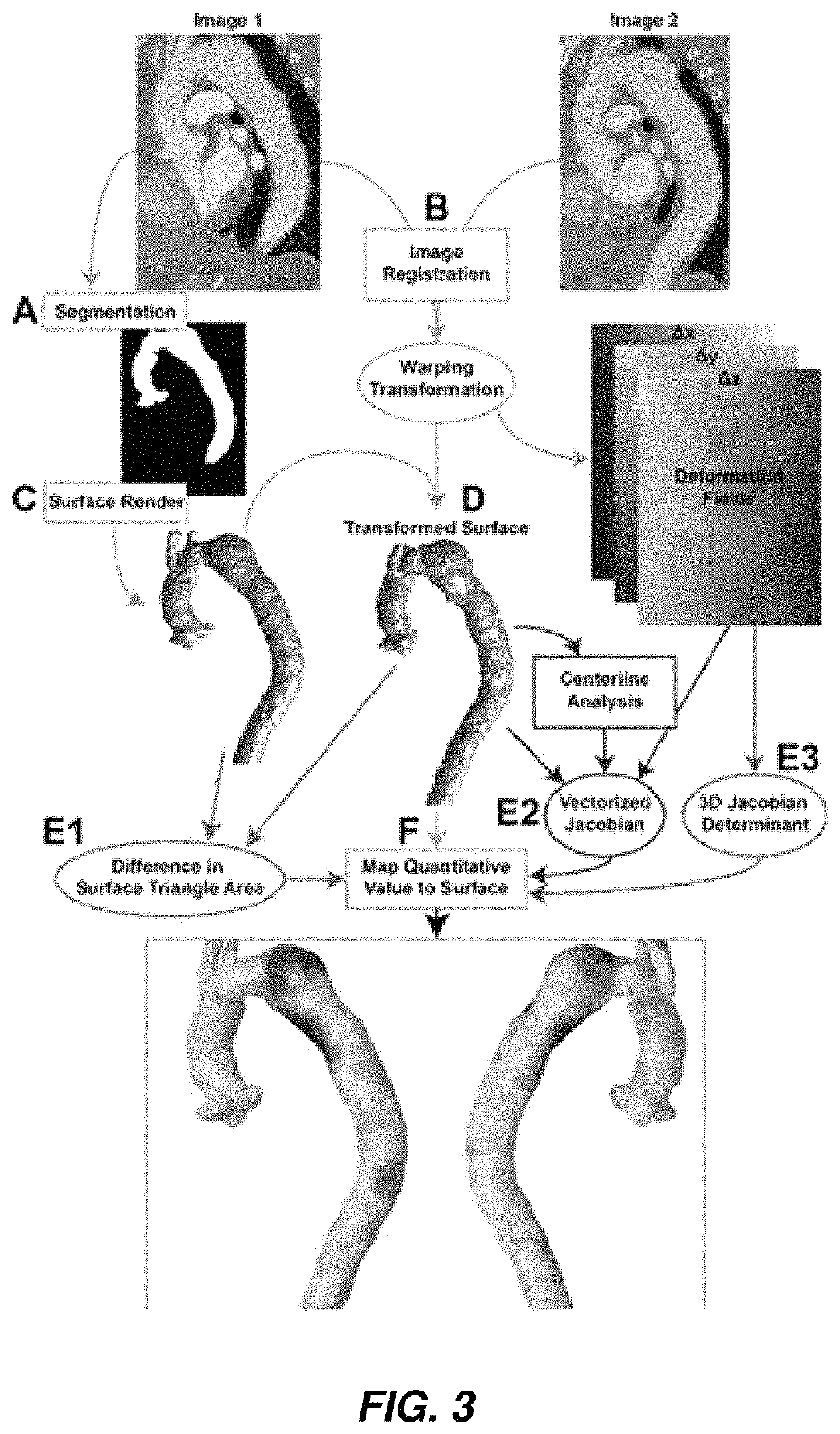 Techniques of deformation analysis for quantification of vascular enlargement