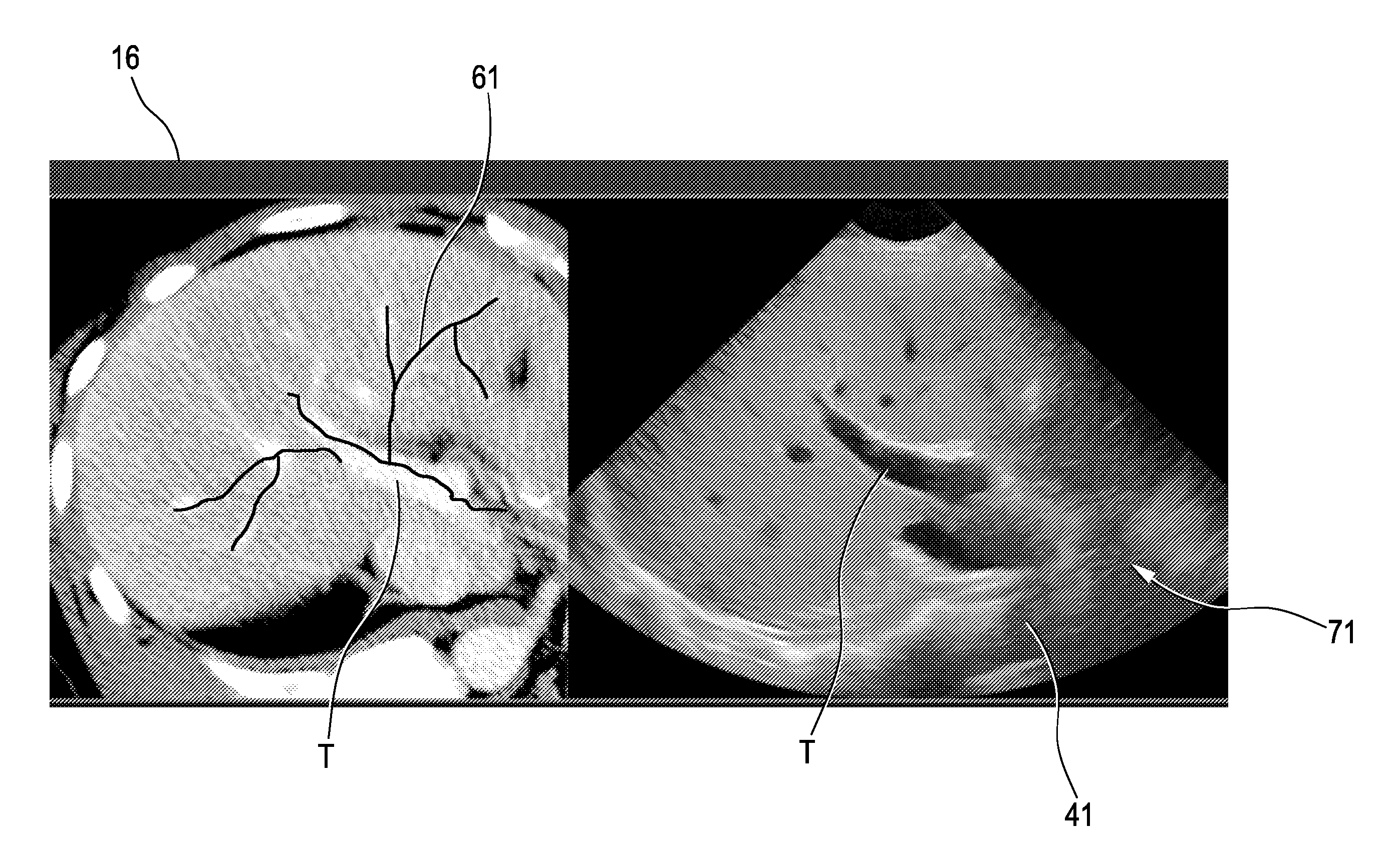 Ultrasound imaging system and method for image guidance procedure