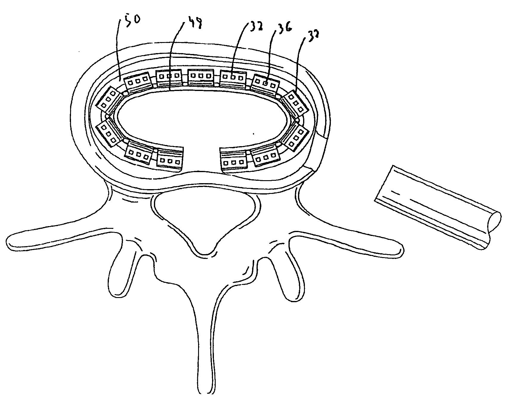 Spinal implant and method of use