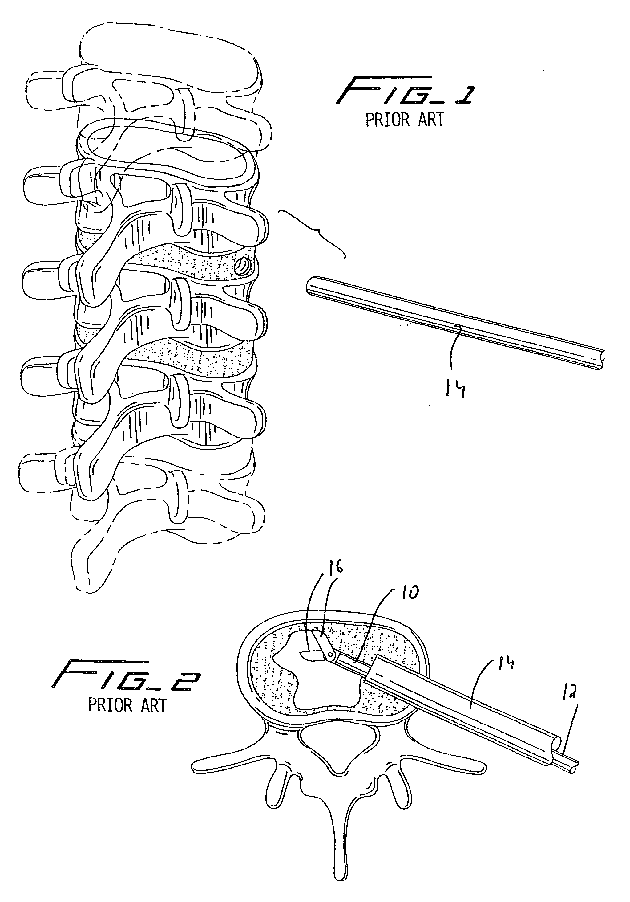 Spinal implant and method of use