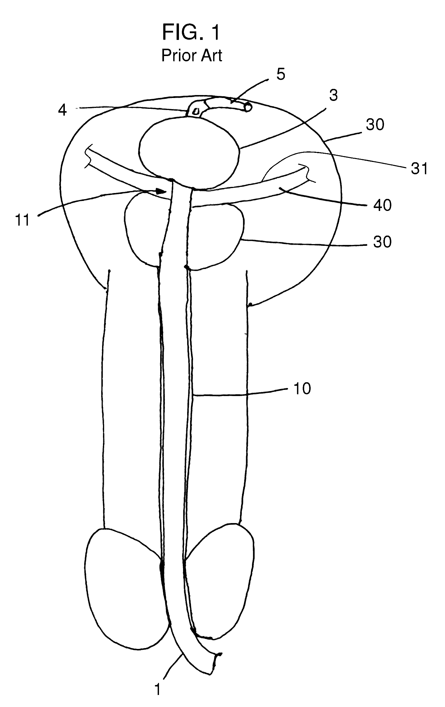 Stretch valve balloon catheter and methods for producing and using same