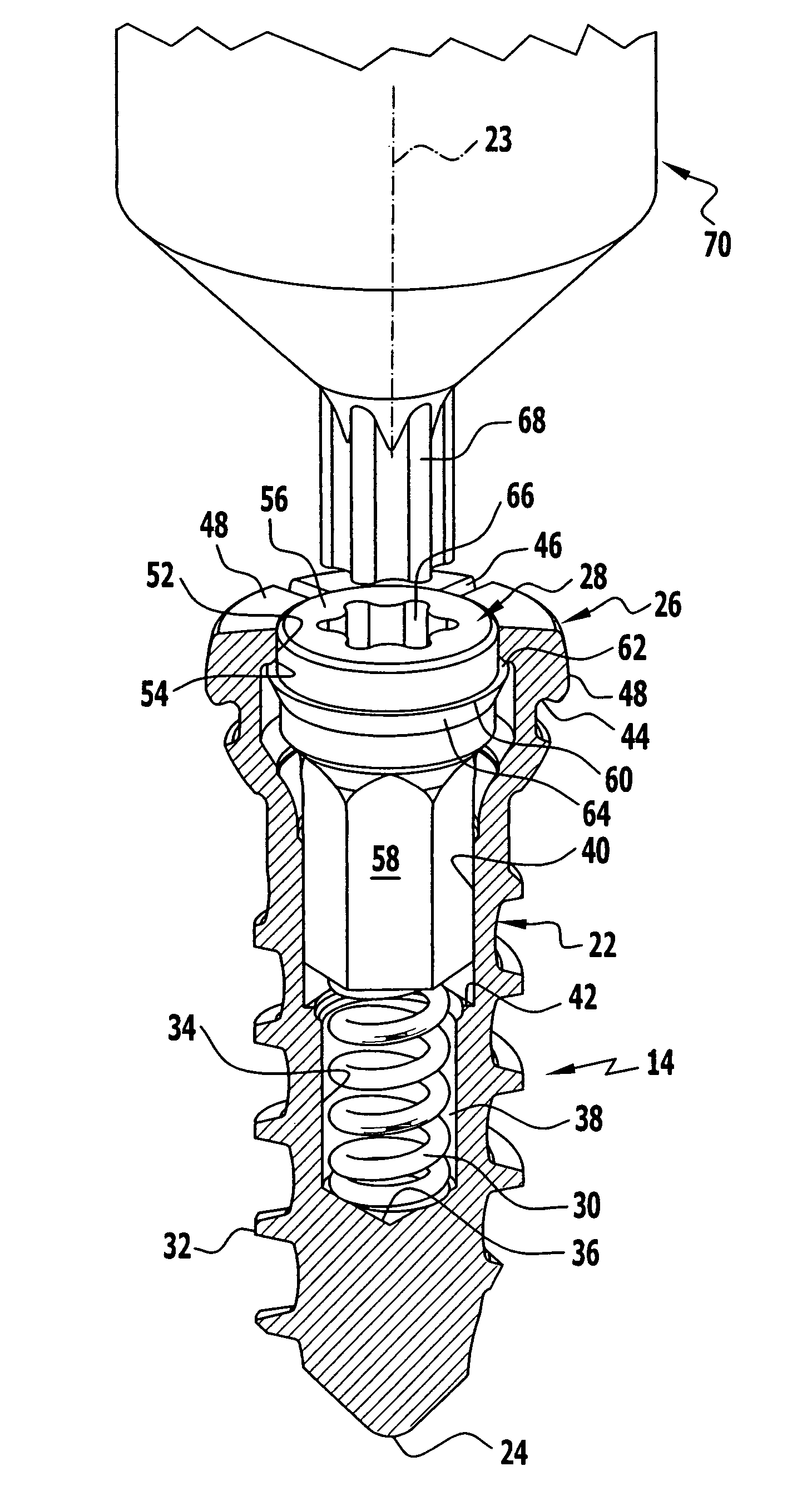 Bone screw