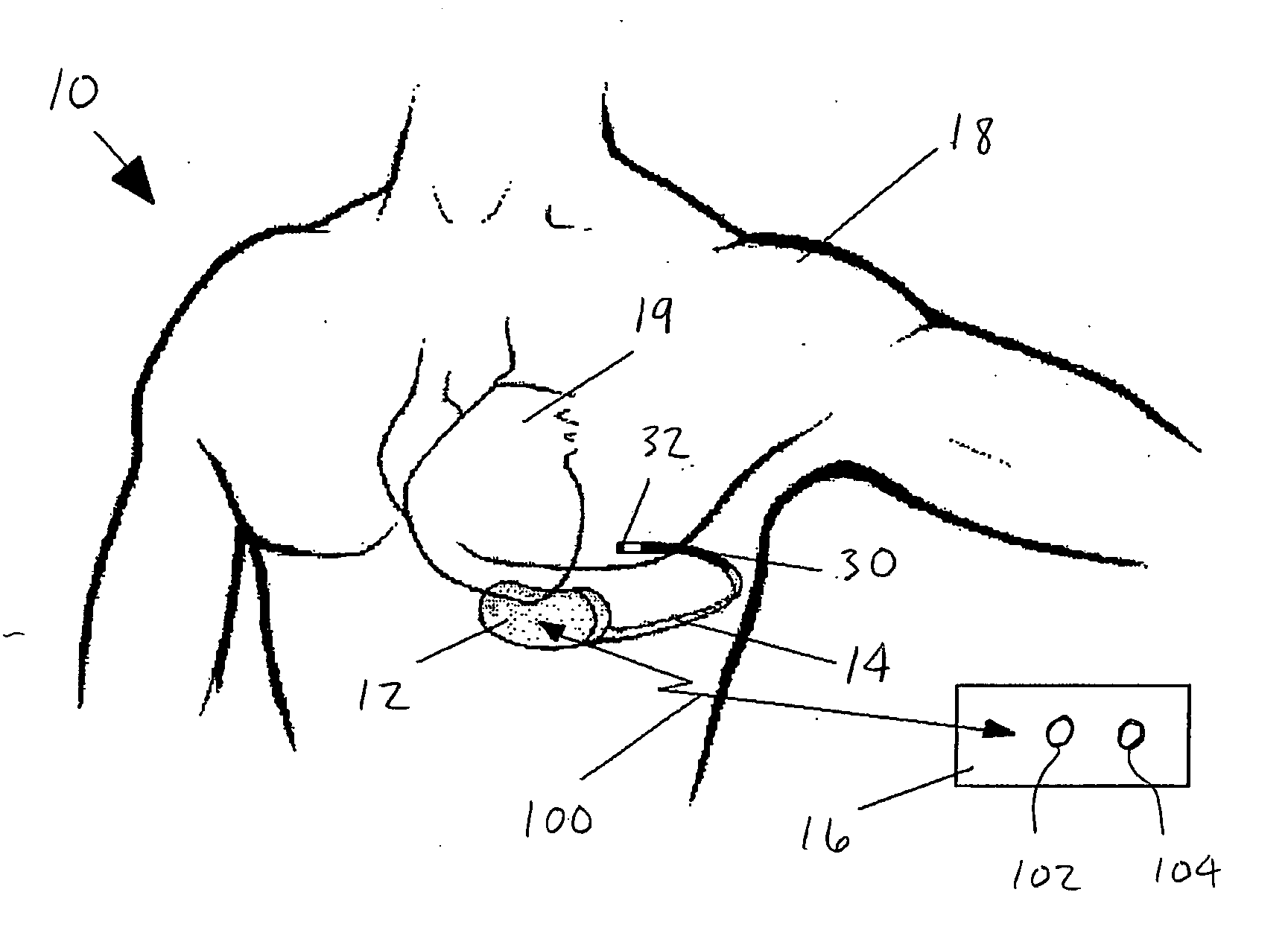 Method and system for aborting cardiac treatments