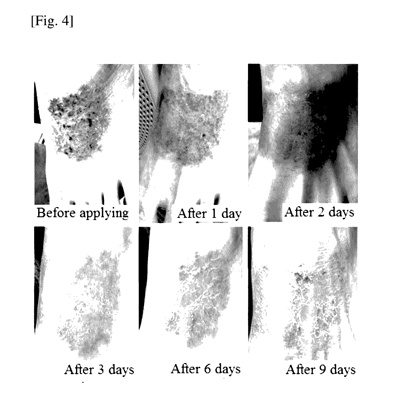 Patch for treating and alleviating symptoms of skin diseases accompanied by effusion of blood proteins