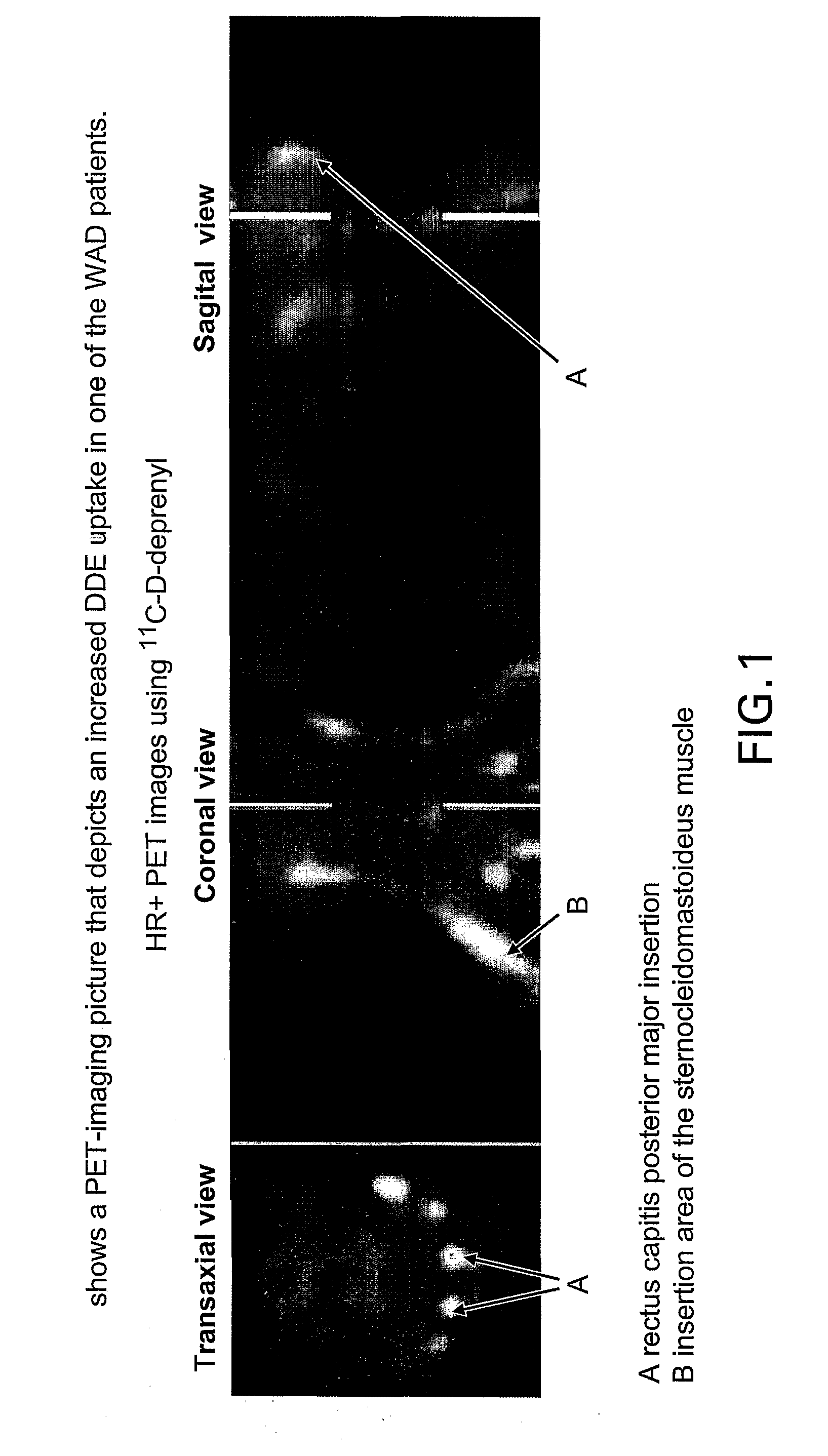 Diagnosis of Whiplash Associated Disorders (Wad) By Using Pet With D-[Methyl-11C]-Deprenyl (Dde)