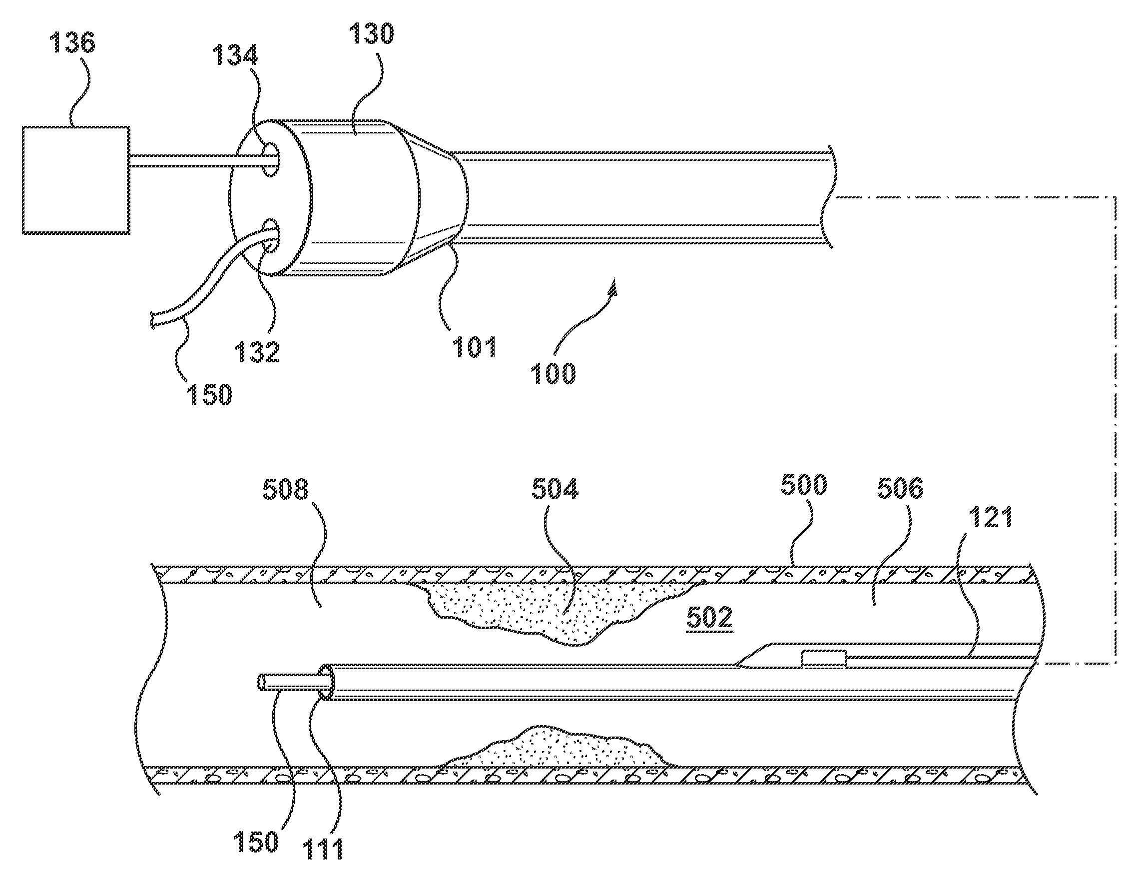 Catheter With Inner Surface Pressure Sensor for Providing a Vascular Pressure Measurement for Determining Fractional Flow Reserve