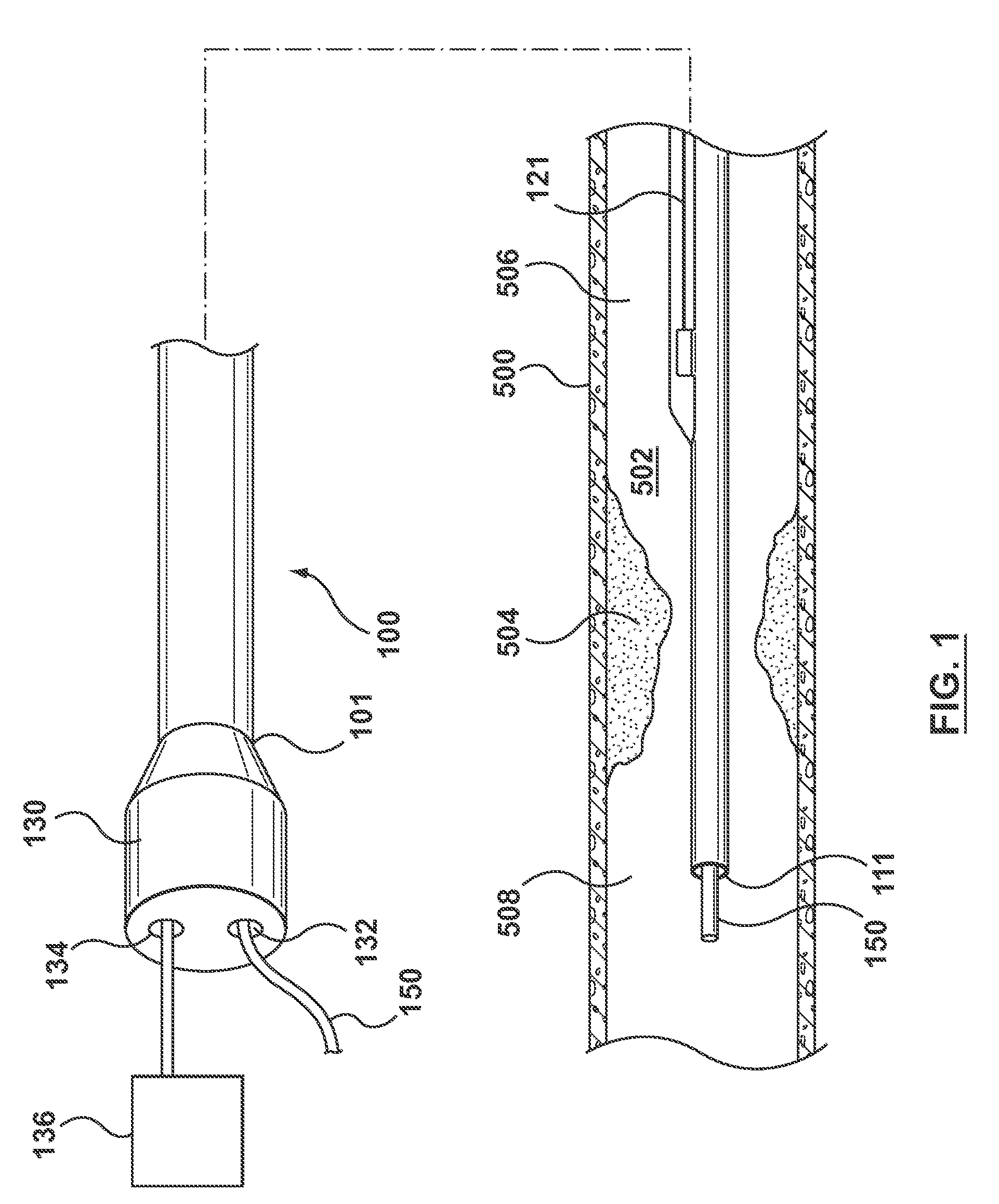 Catheter With Inner Surface Pressure Sensor for Providing a Vascular Pressure Measurement for Determining Fractional Flow Reserve