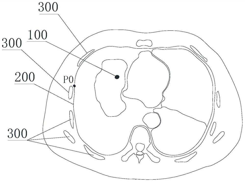 Method for positioning pulmonary nodules