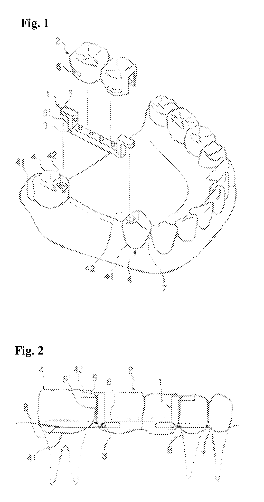 Instant dental bridge