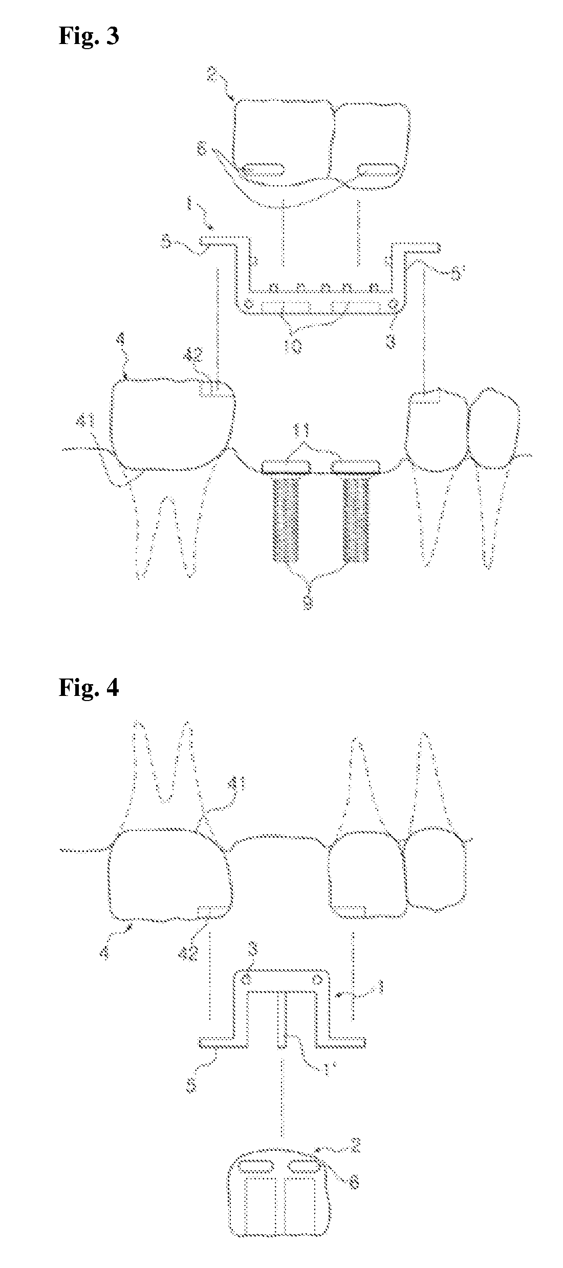 Instant dental bridge