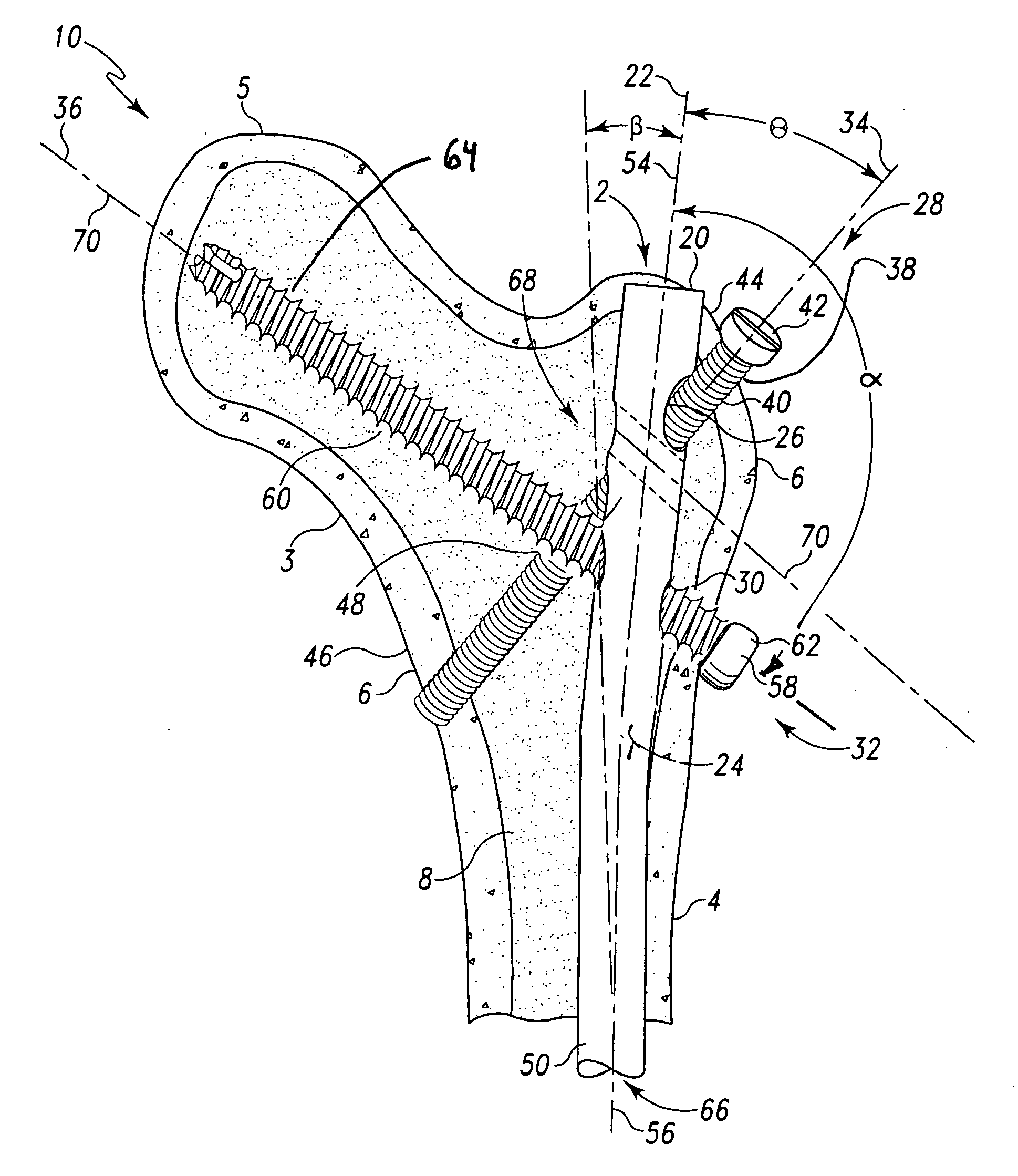 Intramedullary nail with oblique openings