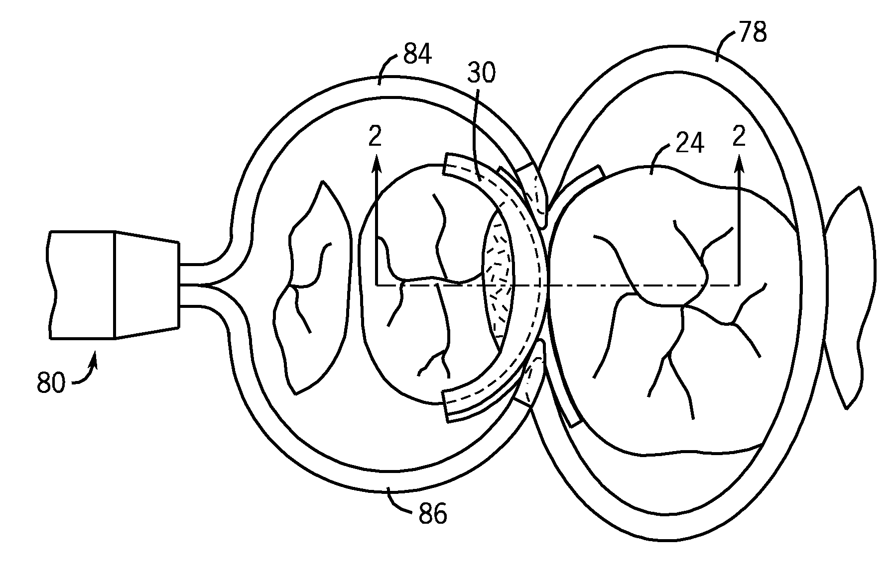 Dental Matrix Devices And A Seamless, Single Load Cavity Preparation And Filling Technique