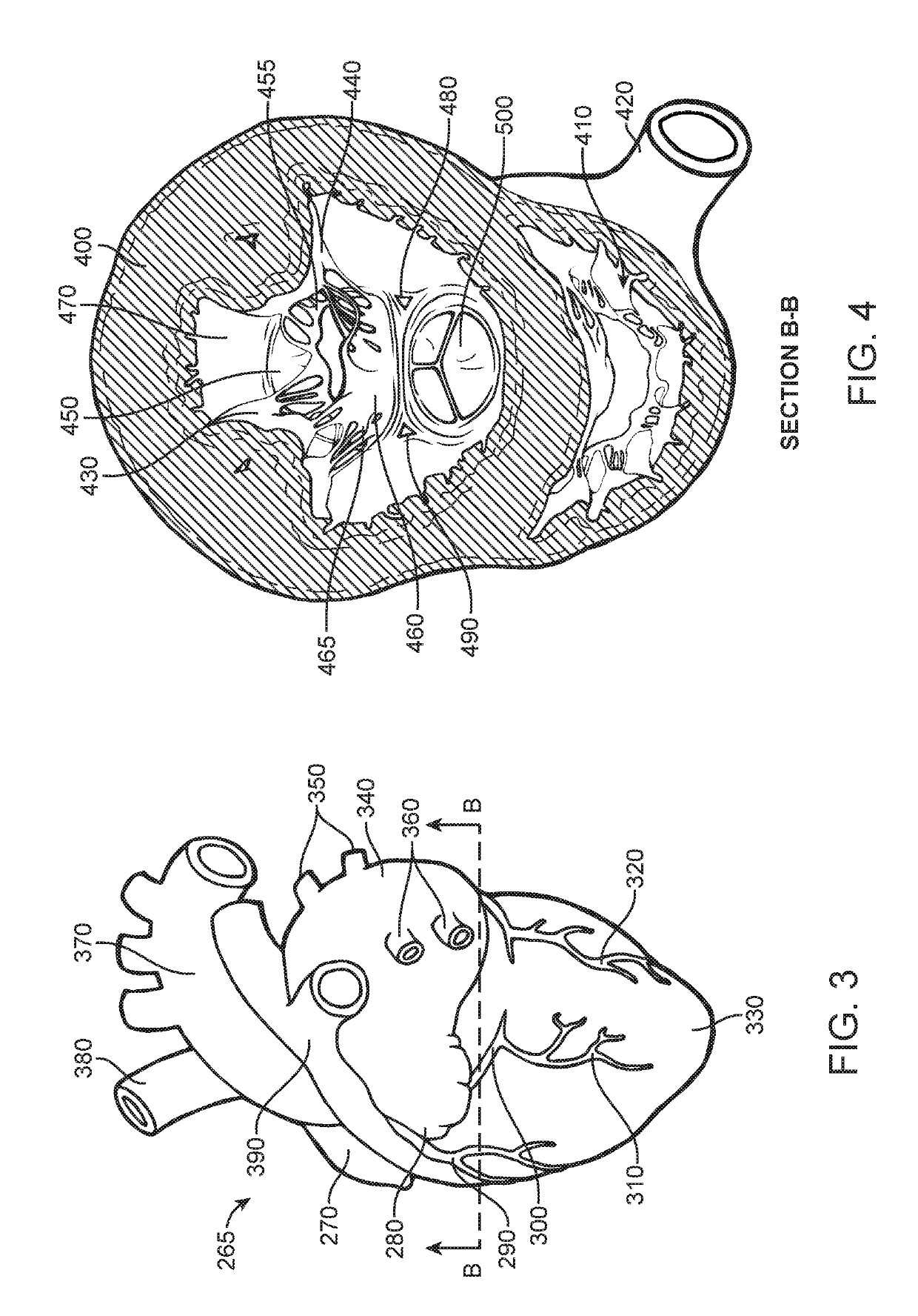 Prosthetic valve for avoiding obstruction of outflow