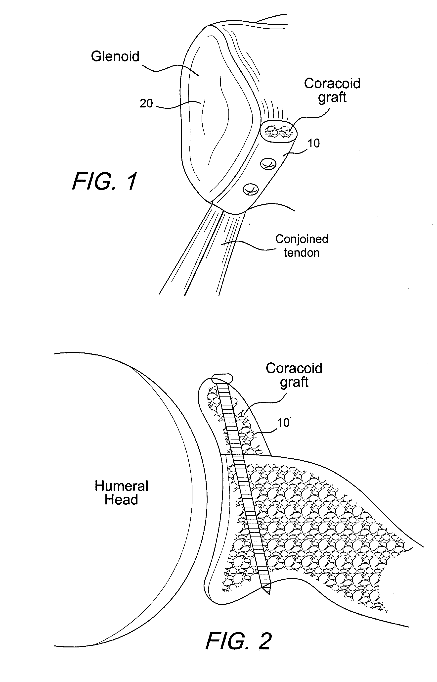 Wedged profile plate