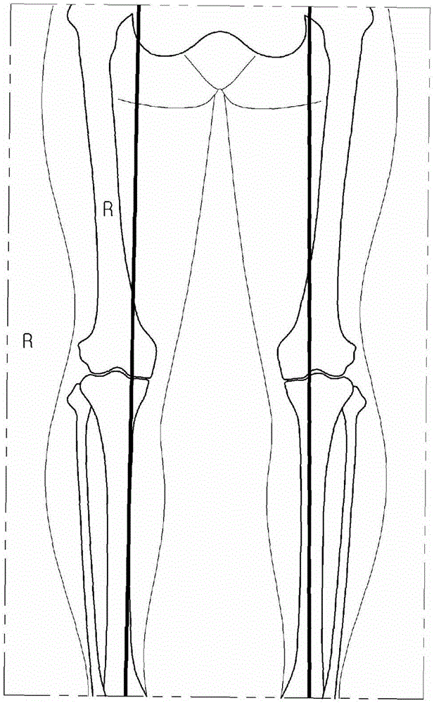 Fixing tool for open-wedge high tibial osteotomy