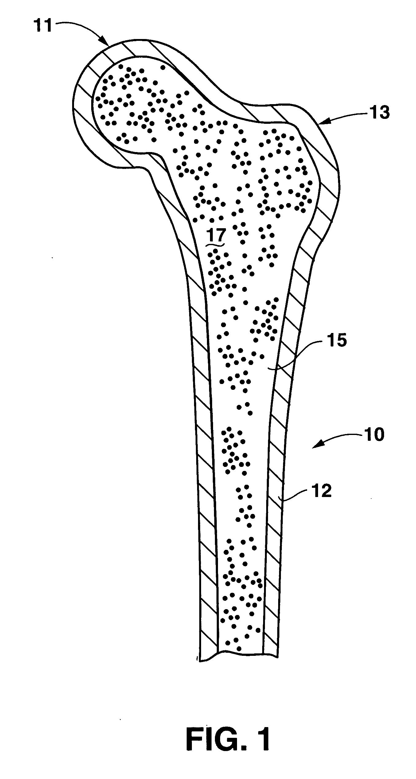 Bone preserving total hip arthroplasty using autograft