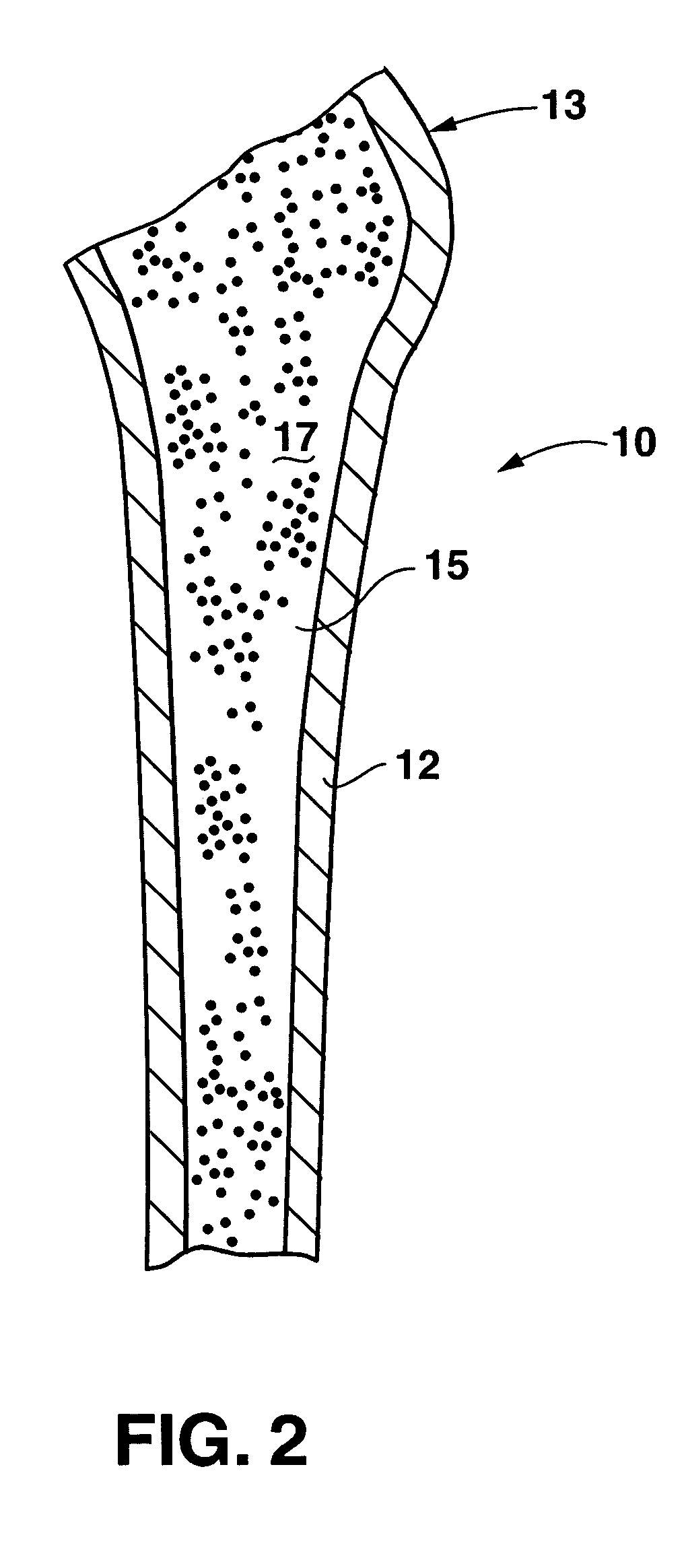 Bone preserving total hip arthroplasty using autograft