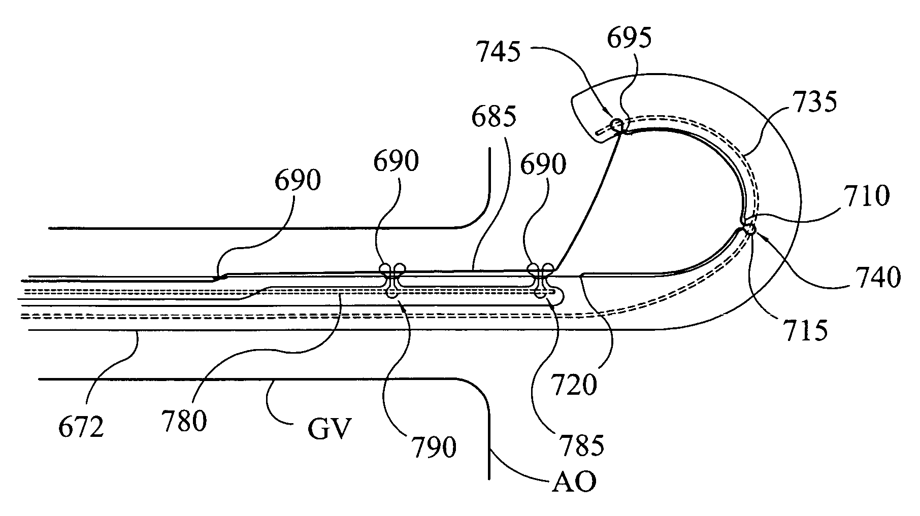 Closable loop access guide catheter