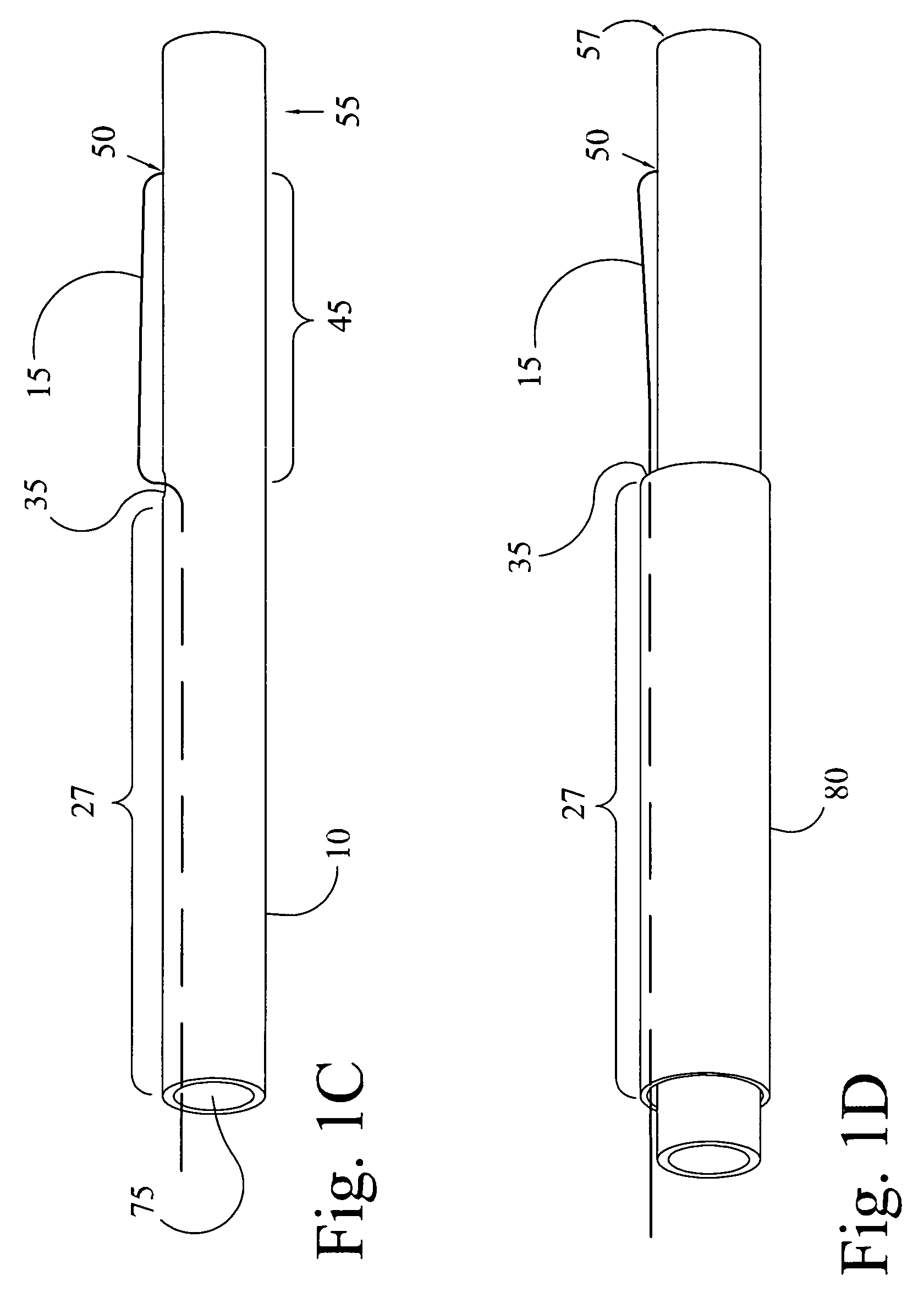 Closable loop access guide catheter