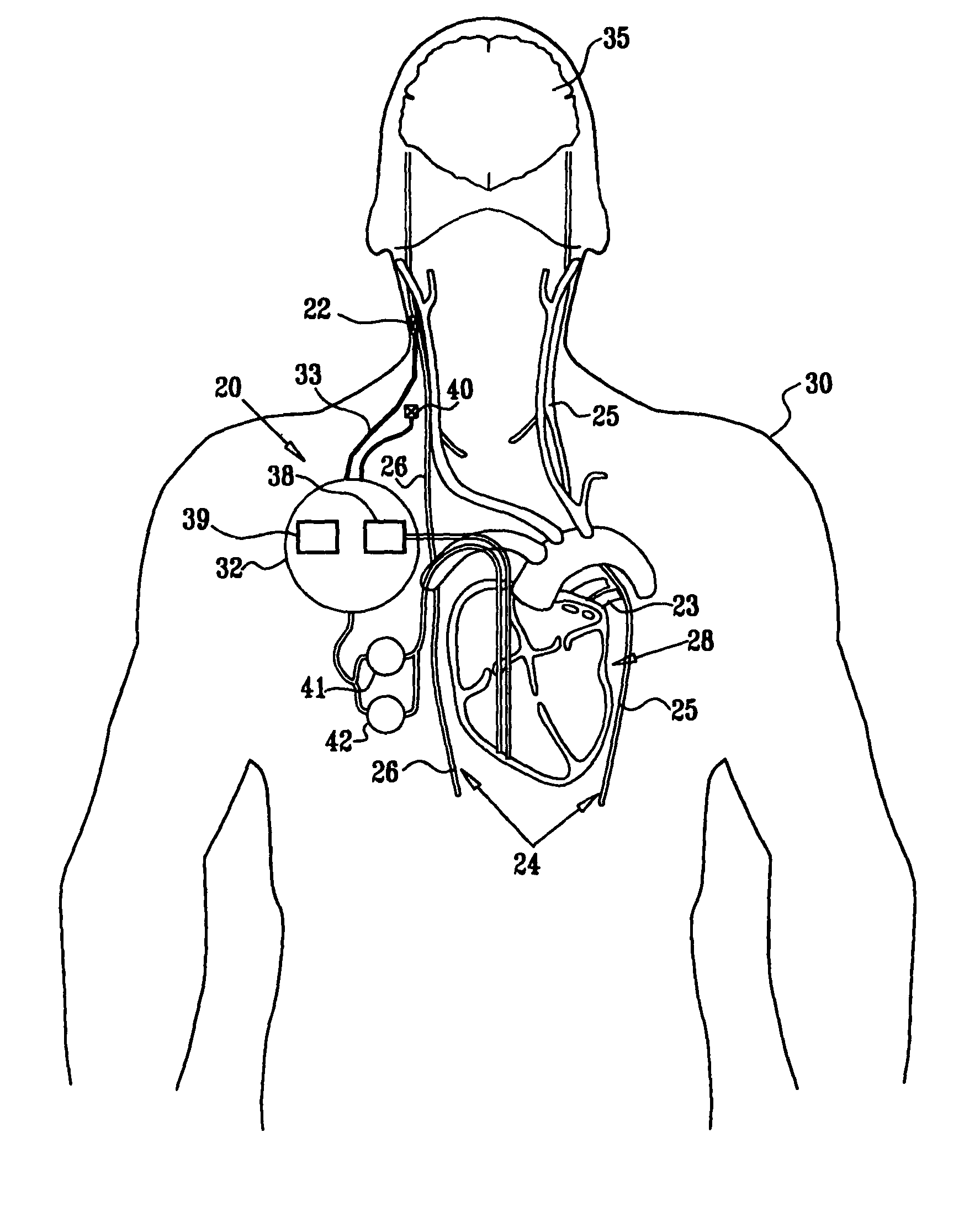 Parasympathetic stimulation for prevention and treatment of atrial fibrillation