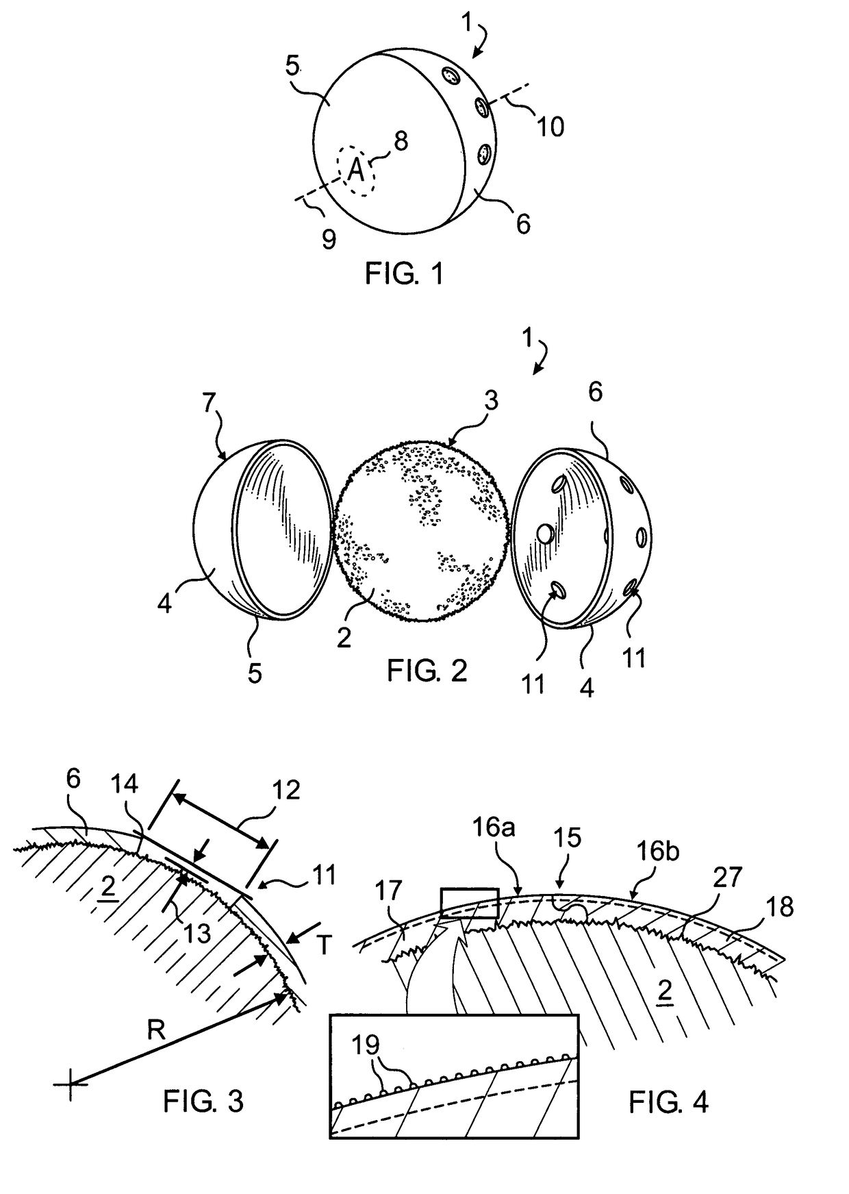 Orbital implant coating having bulbously raised suture zone