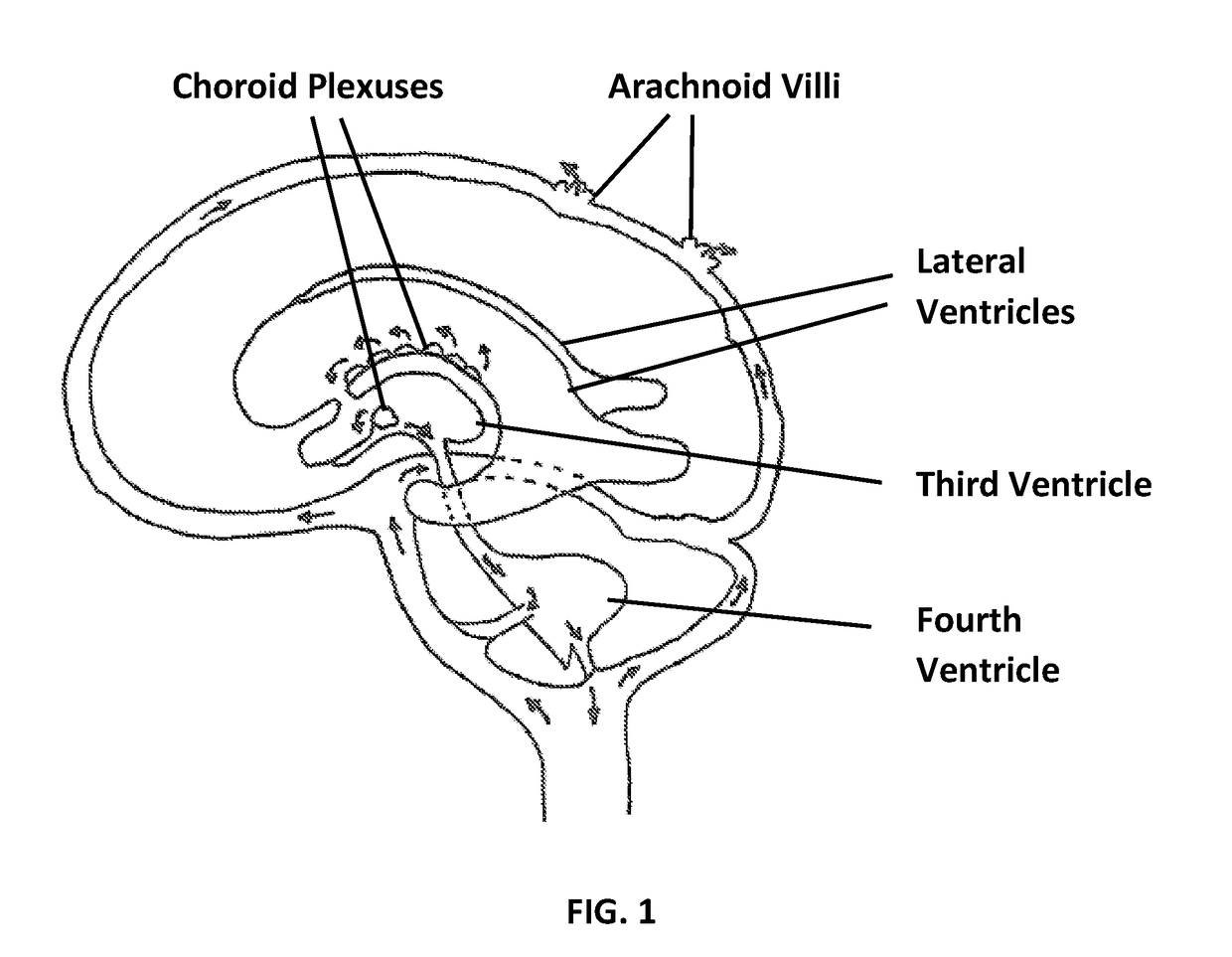 Method of Preventing Traumatic Brain Injury (TBI)