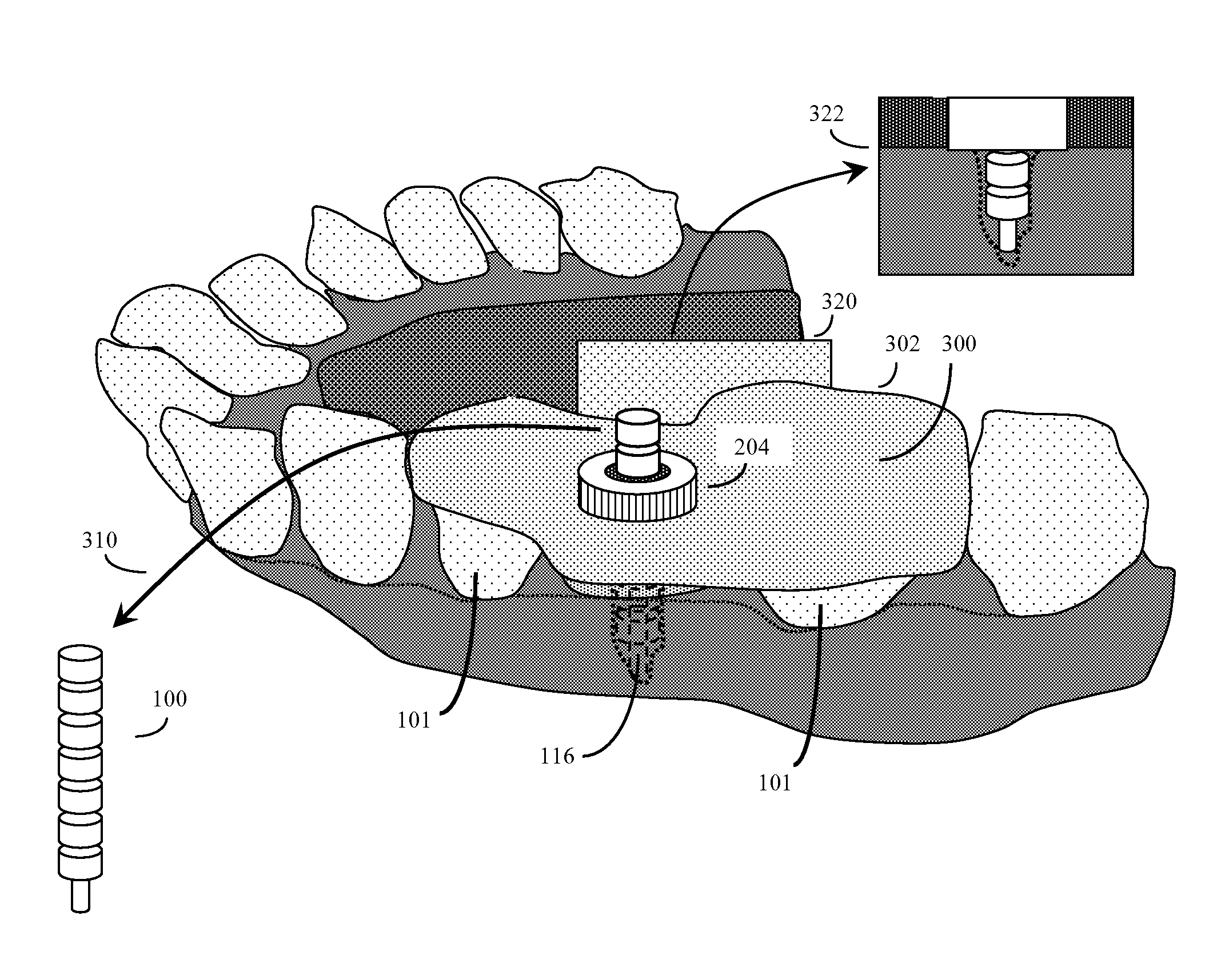 Method and kit for producing dental implant drilling guides