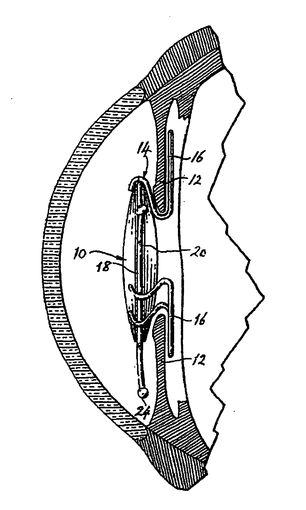 Intraocular implant