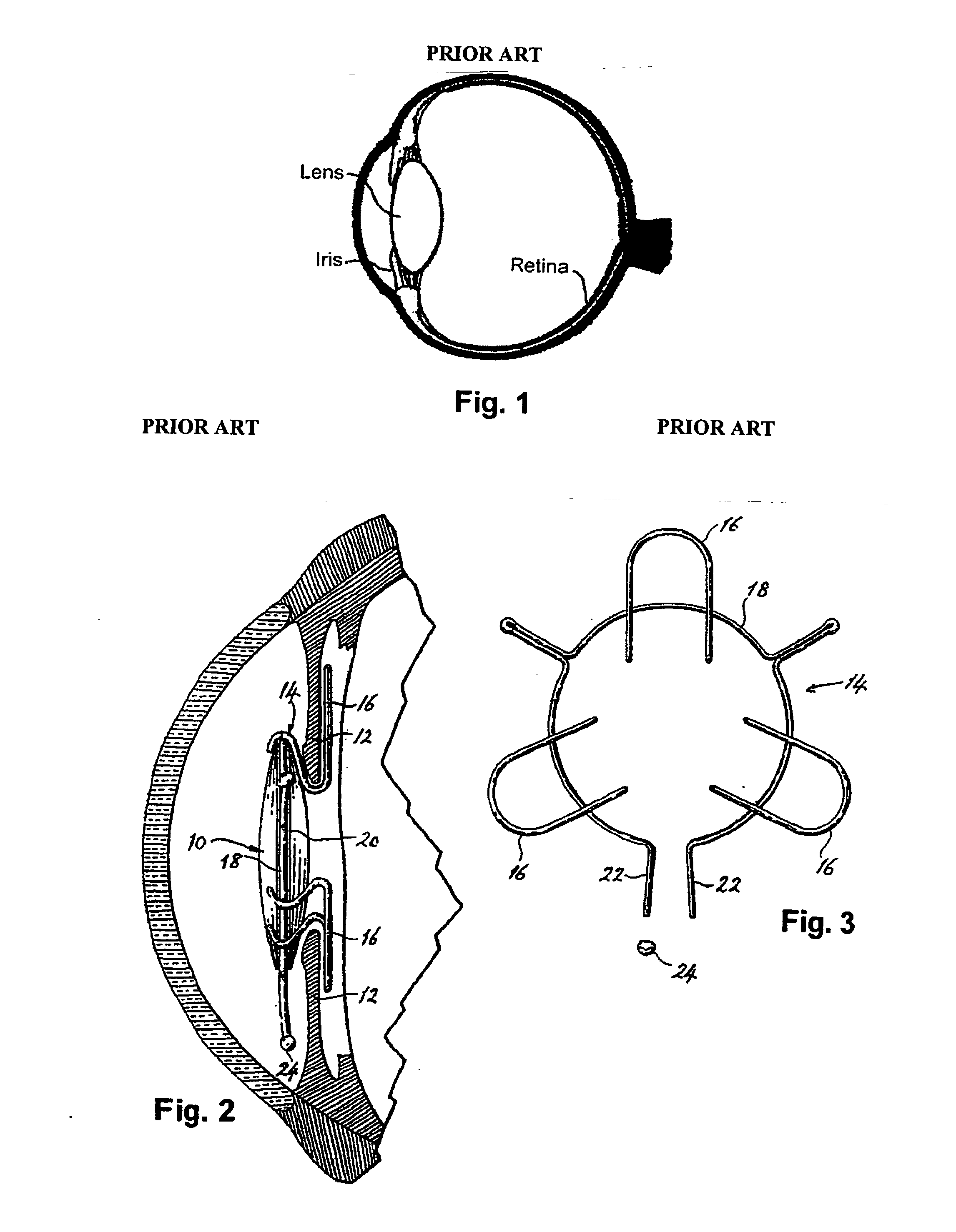 Intraocular implant