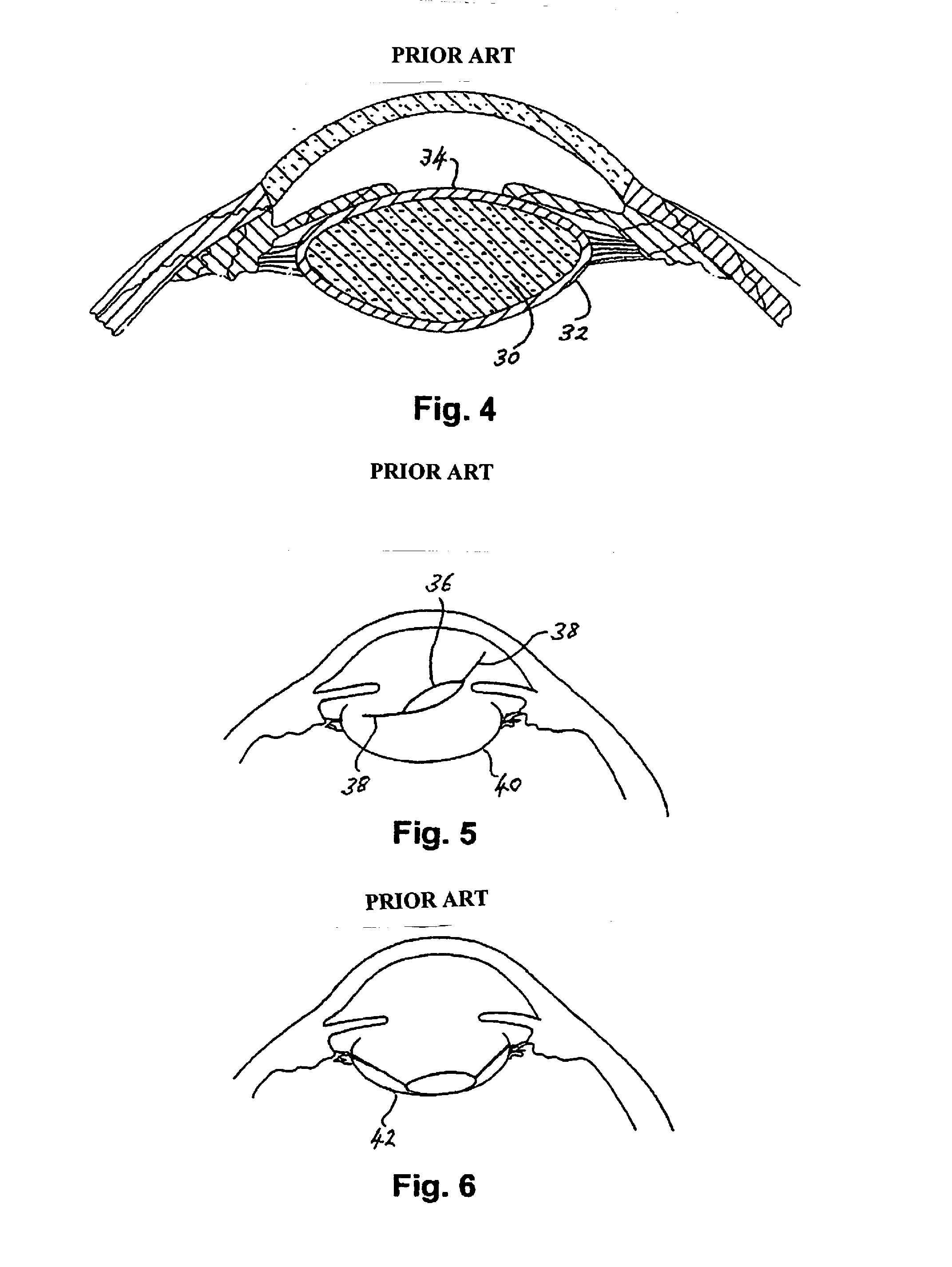 Intraocular implant