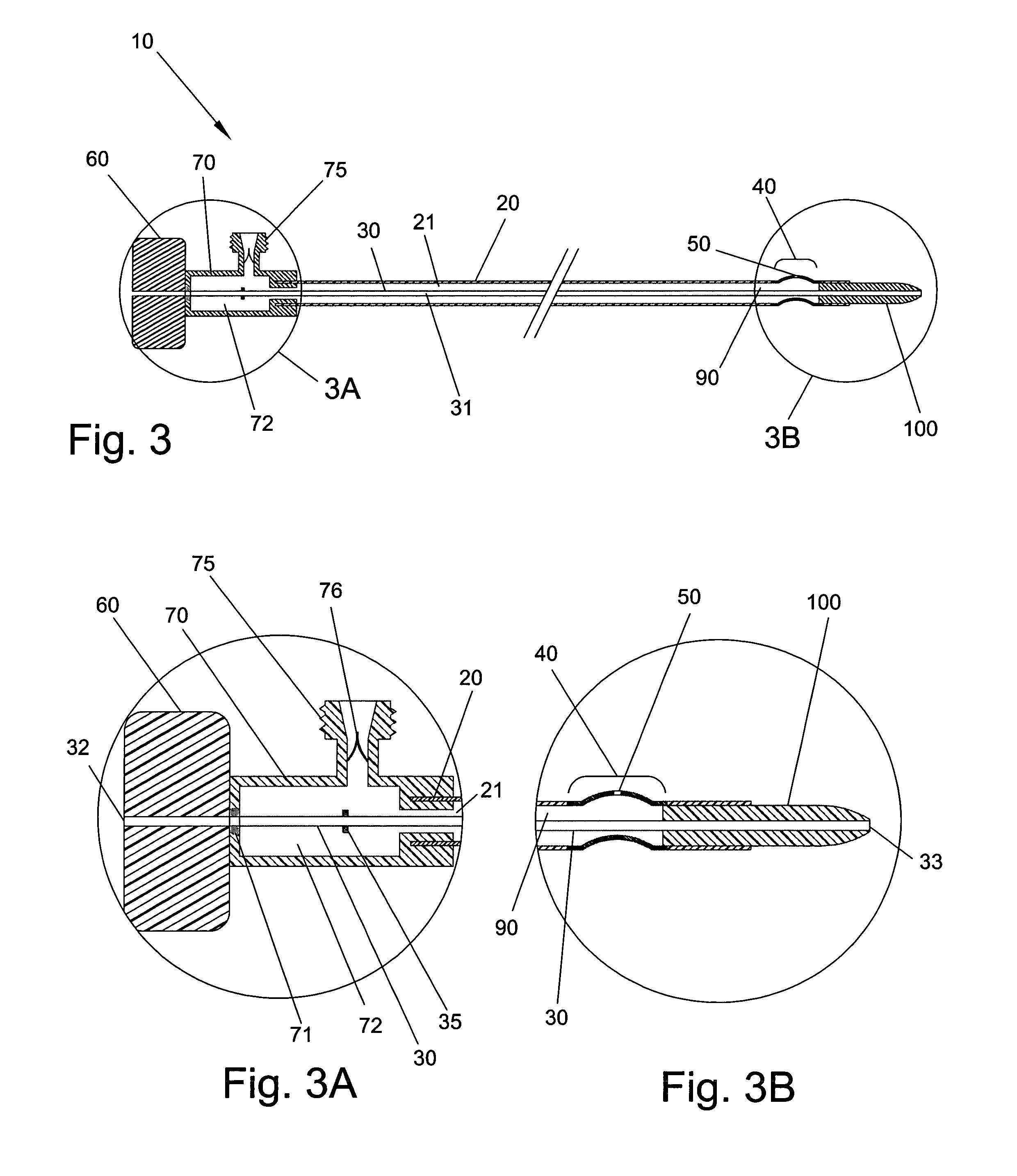 Material removal catheter and method