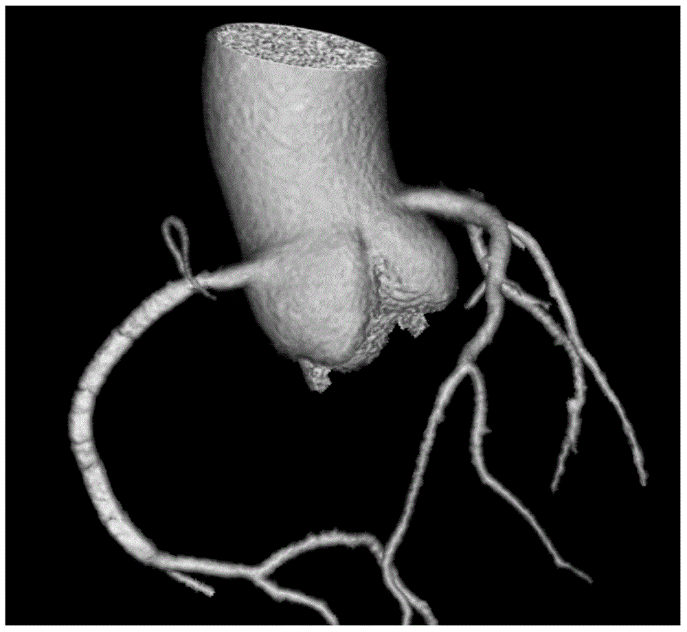 Construction method of three-dimensional coronary artery analysis model and system thereof