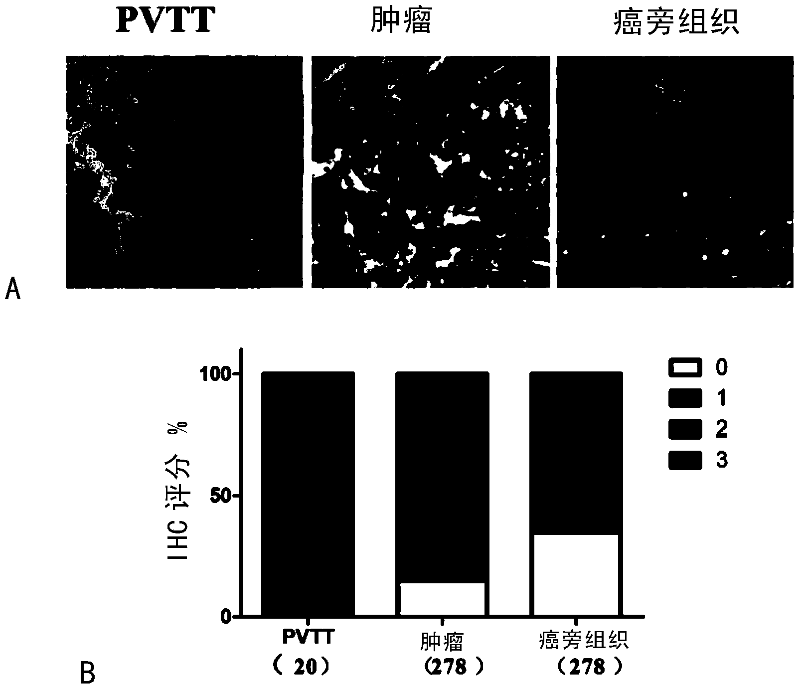 Application of RNA (Ribose Nucleic Acid) polymerase II fifth subunit regulatory protein in preparation of reagent for prognosis of hepatocellular carcinoma or auxiliary TACE (Transcatheter Arterial Chemoembolization)