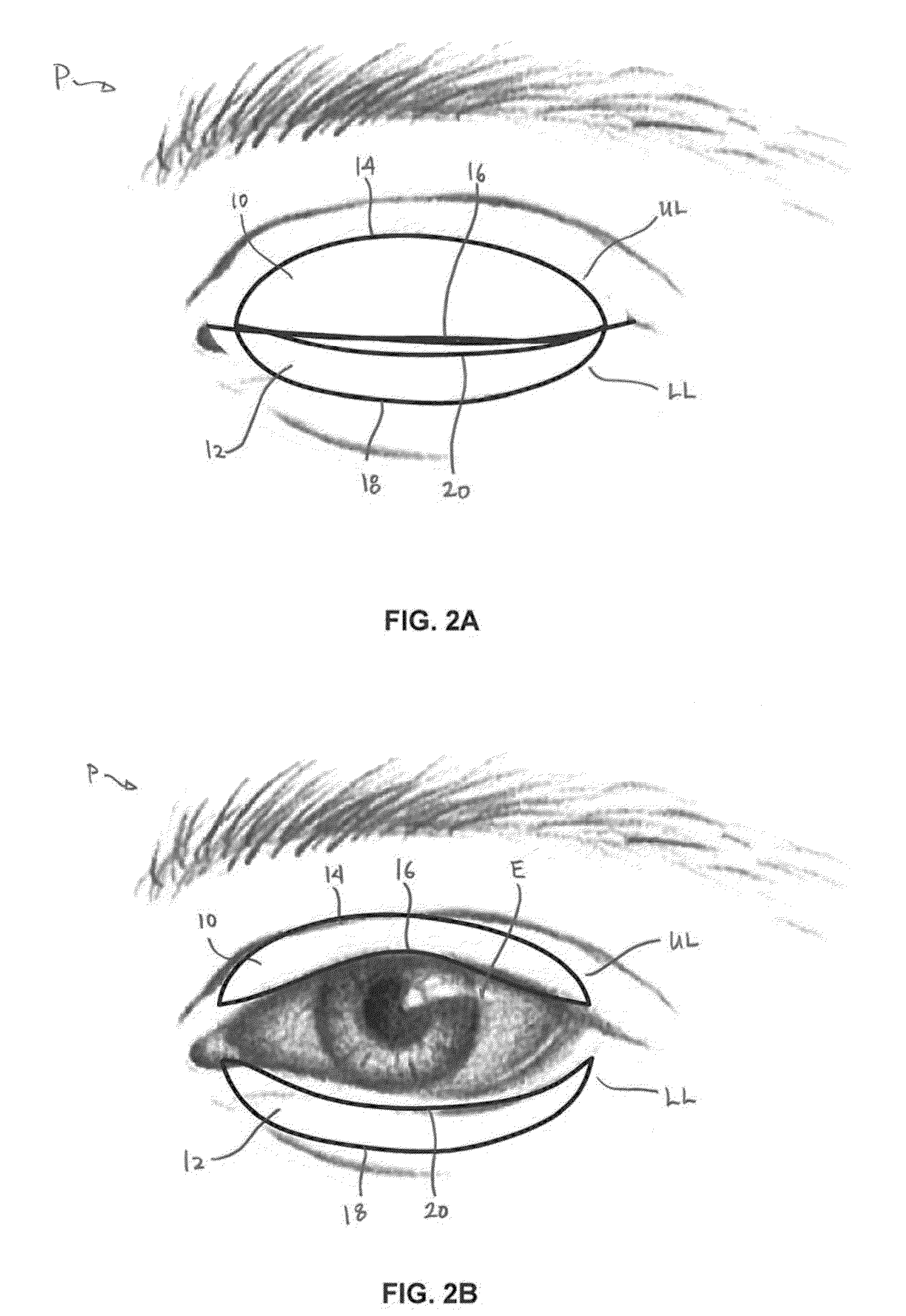 Dry eye treatment systems