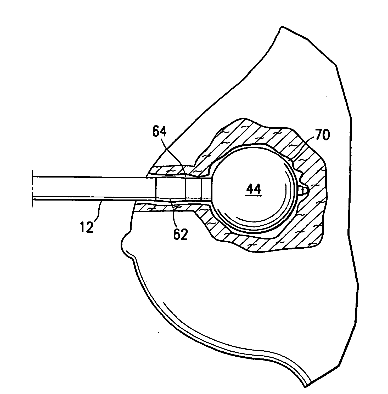 Tissue irradiation