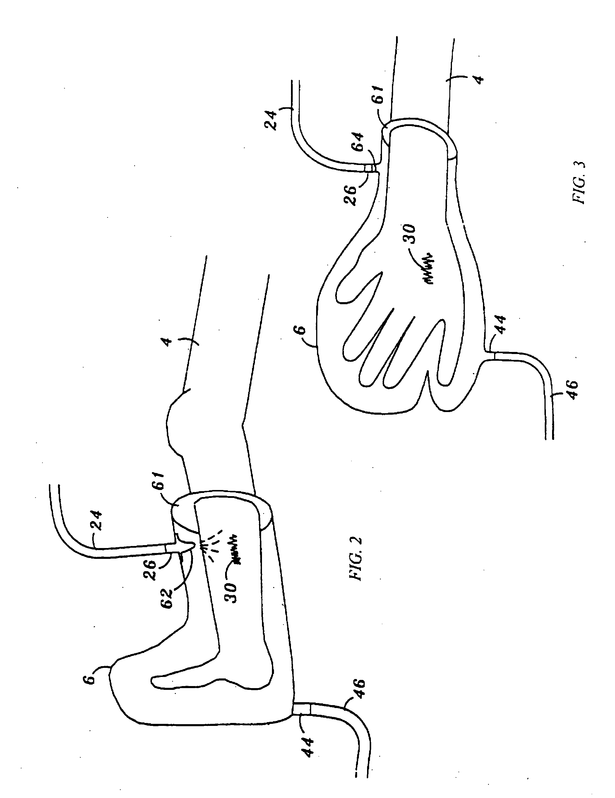 Device and method for treatment of wounds with nitric oxide