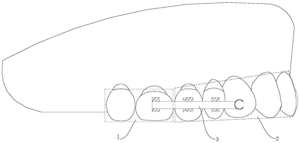 Orthosis for jaw leveling