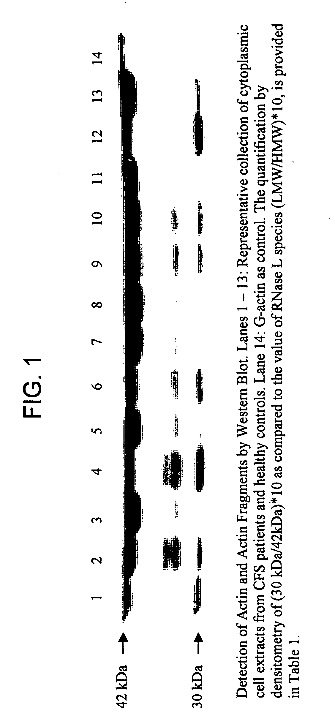 Methods and compositions for use in diagnosing and characterizing chronic immune disease