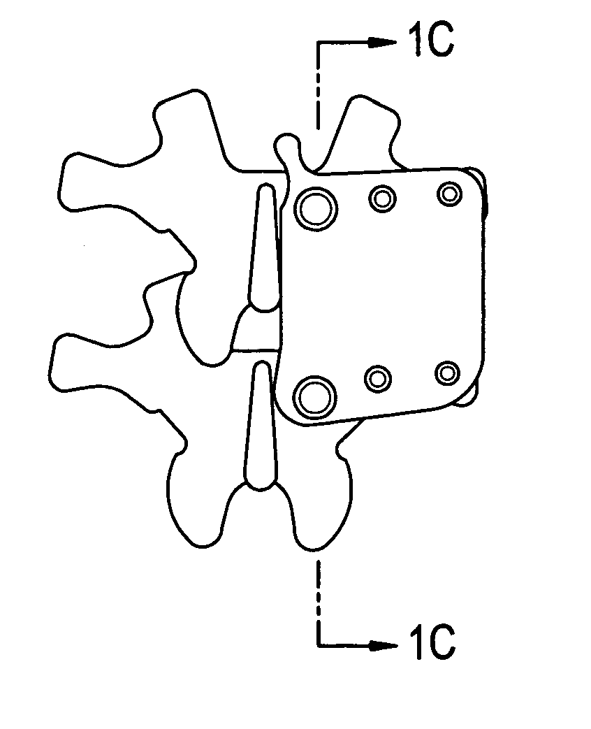 In-situ formed posterolateral fusion system