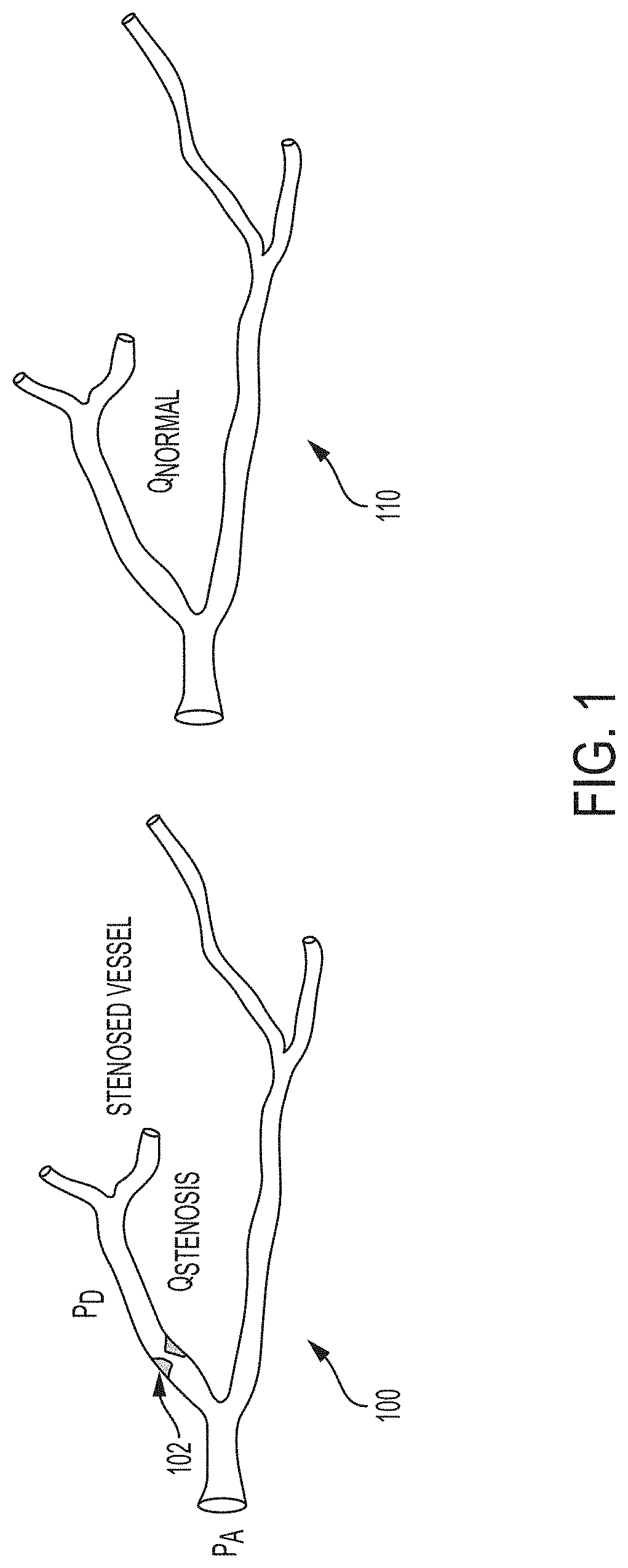 Method and system for non-invasive functional assessment of coronary artery stenosis using flow computations in diseased and hypothetical normal anatomical models