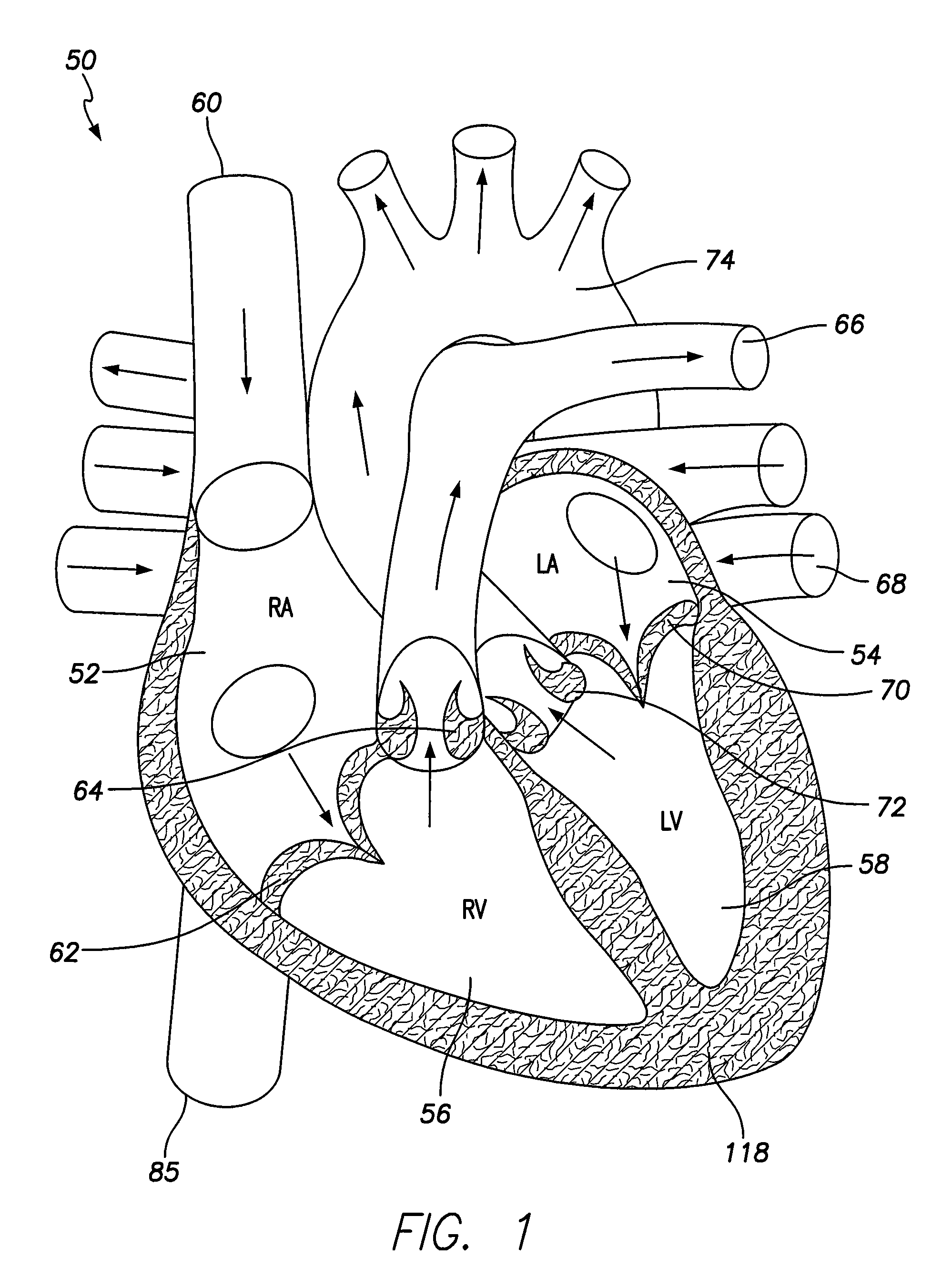 Multi-piece dual-chamber leadless intra-cardiac medical device and method of implanting same