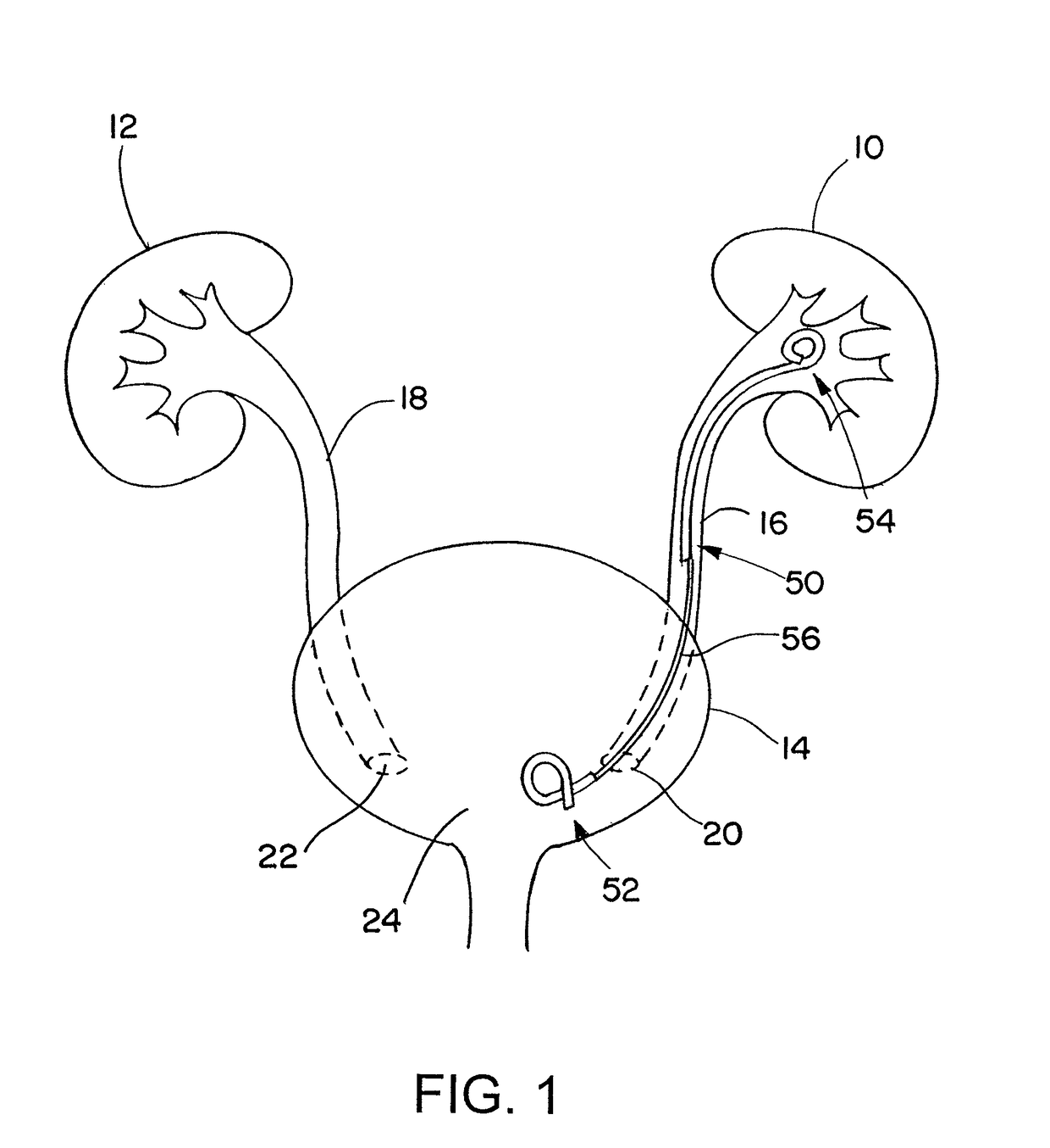 Ureteral stent for placement in a kidney and bladder