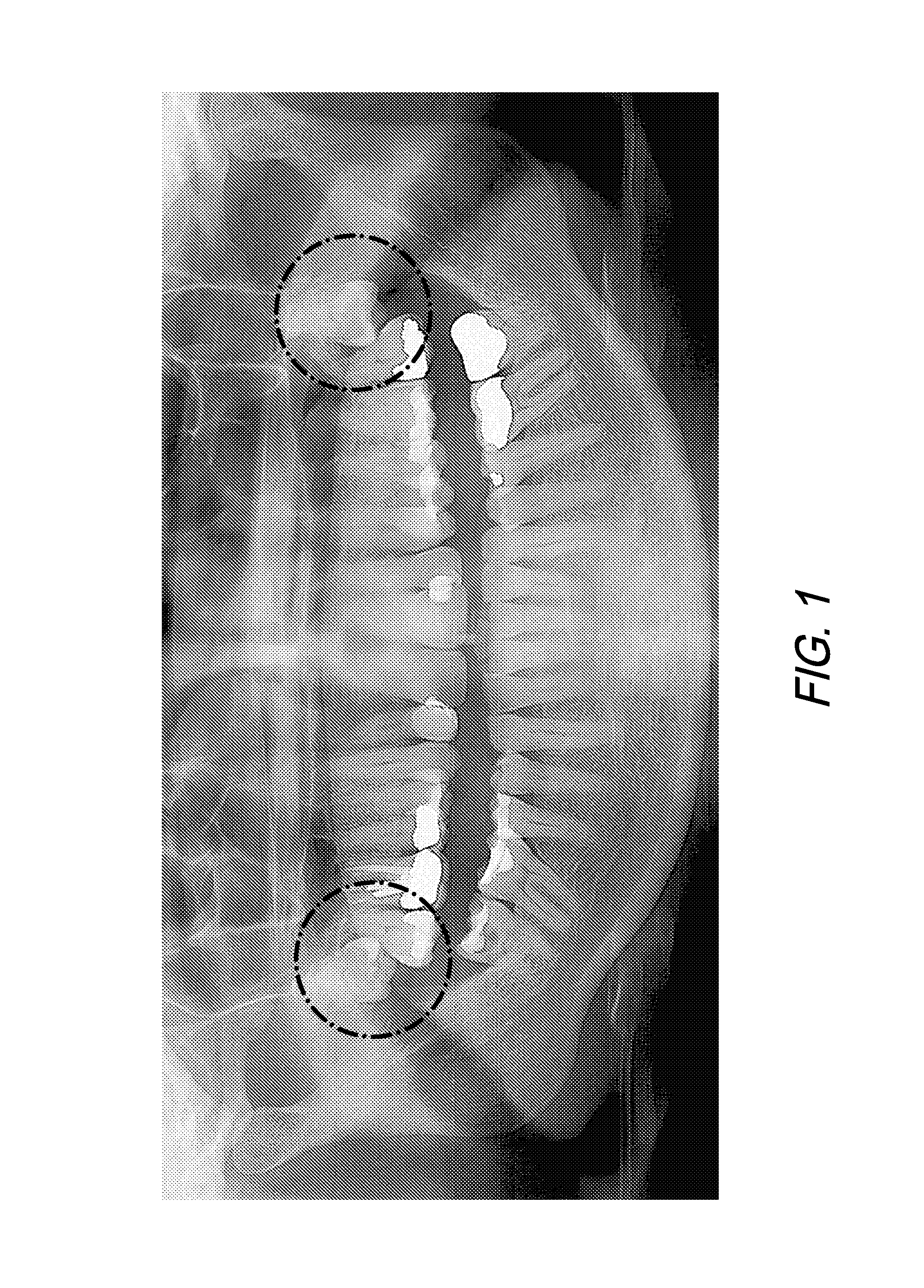 Therapeutic Tooth Bud Ablation