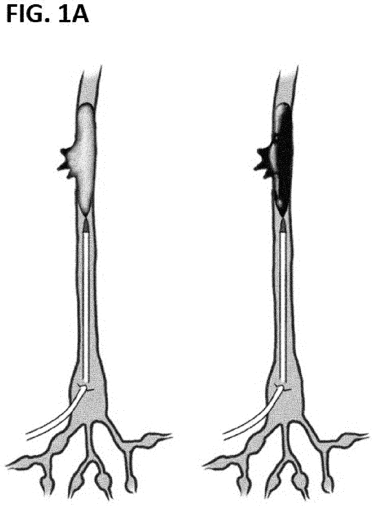 Novel glue for embolization of lymphatic leakage