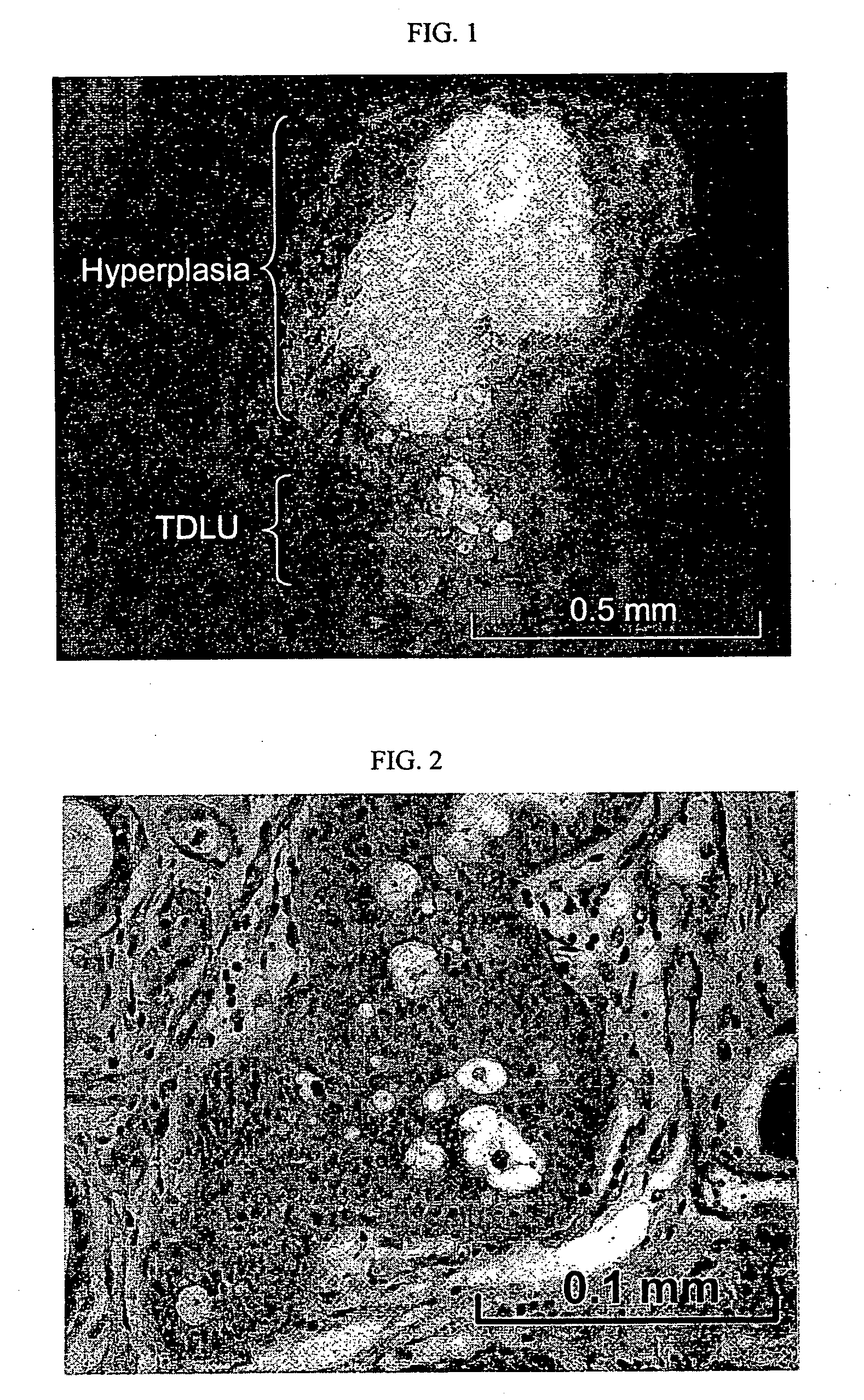 Reconstituted human breast tumor model