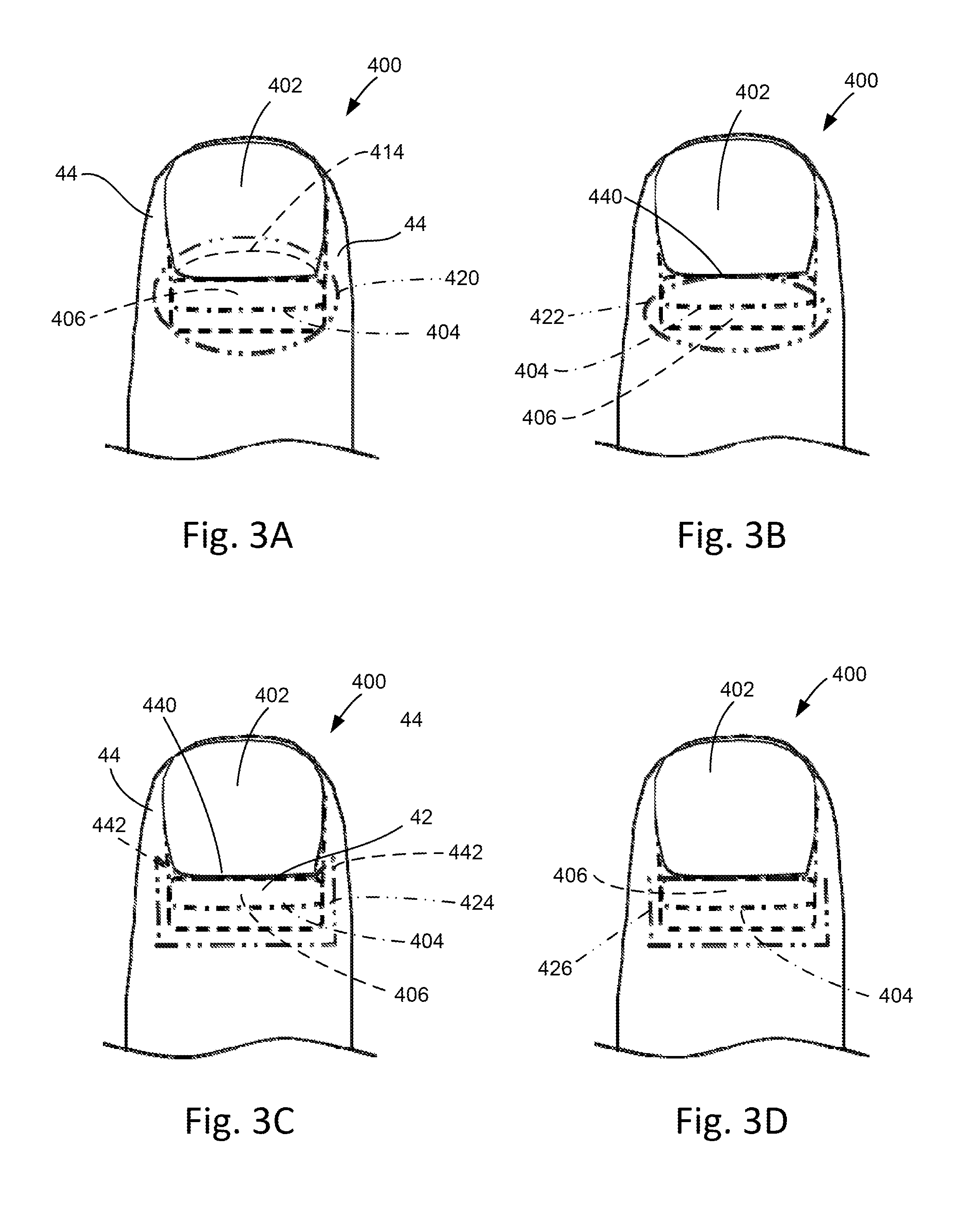 Treatment of nail disorders