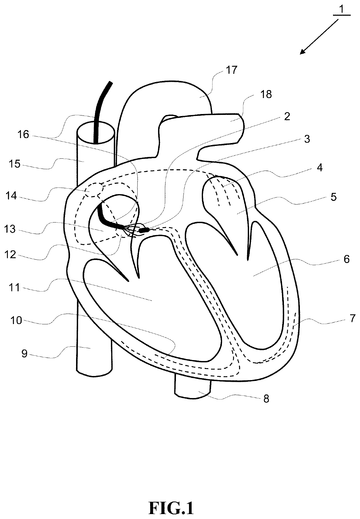 Single conduit multi-electrode cardiac pacemaker and methods of using thereof