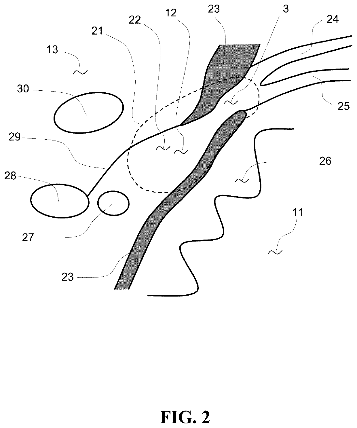 Single conduit multi-electrode cardiac pacemaker and methods of using thereof