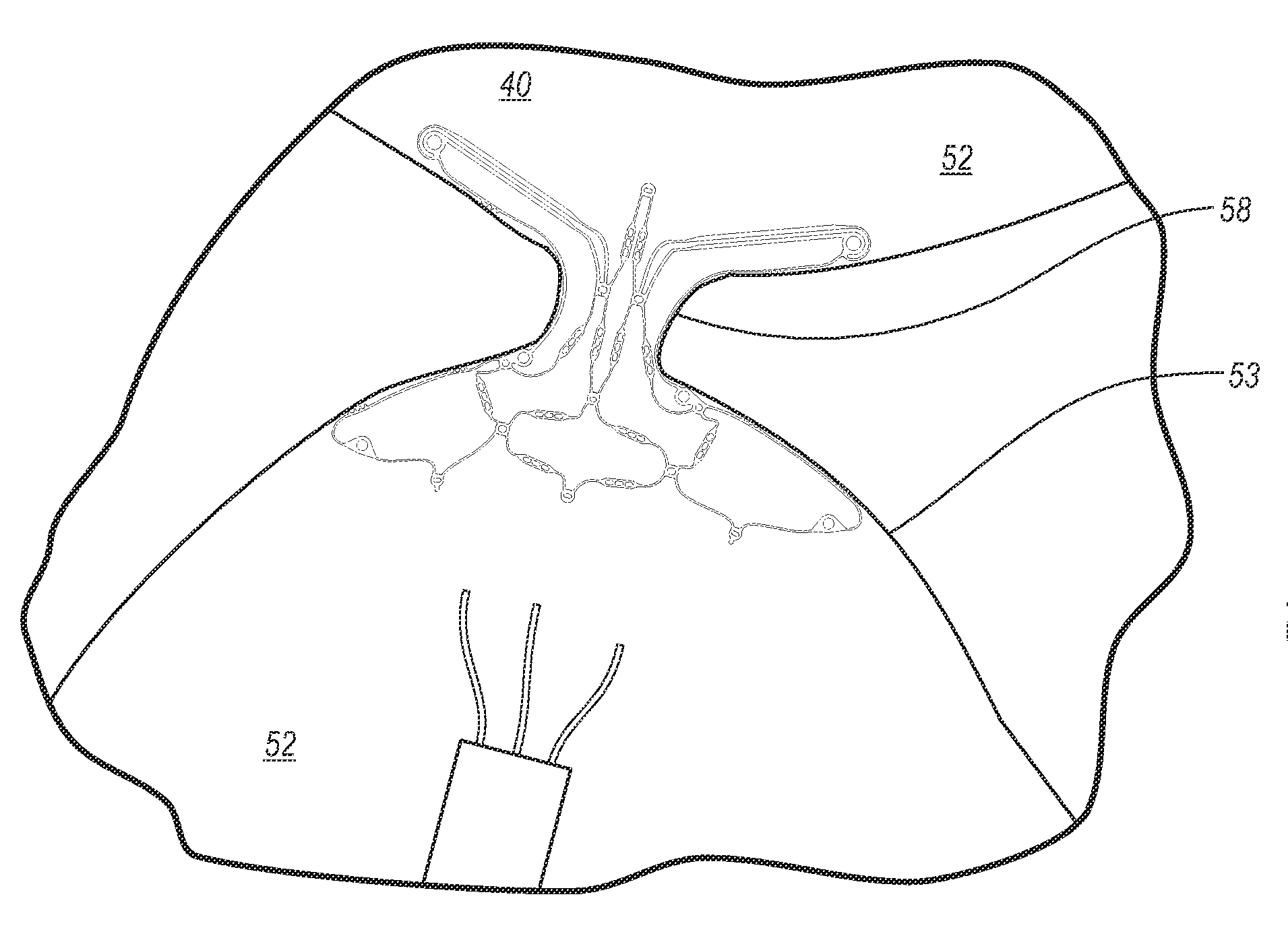 Devices for reducing the size of an internal tissue opening