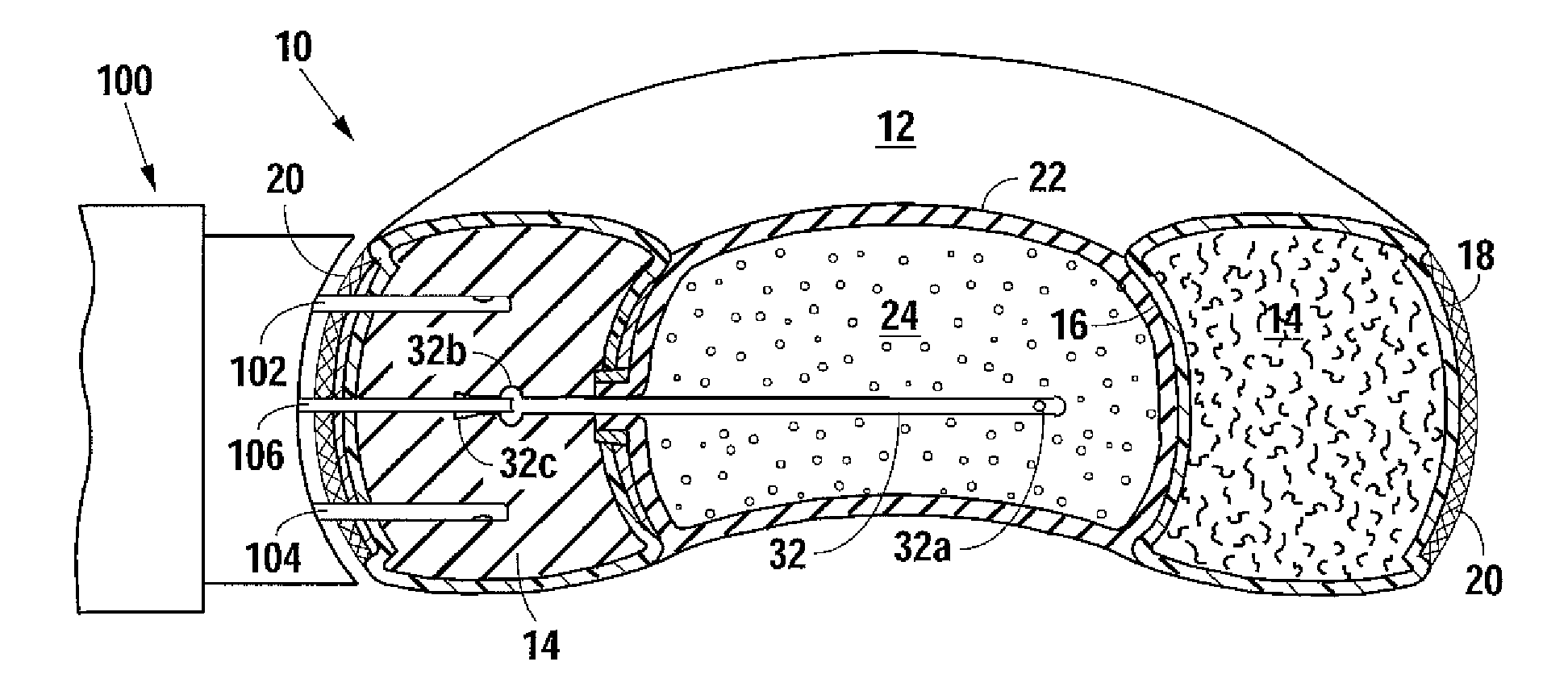 Percutaneous implantable nuclear prosthesis